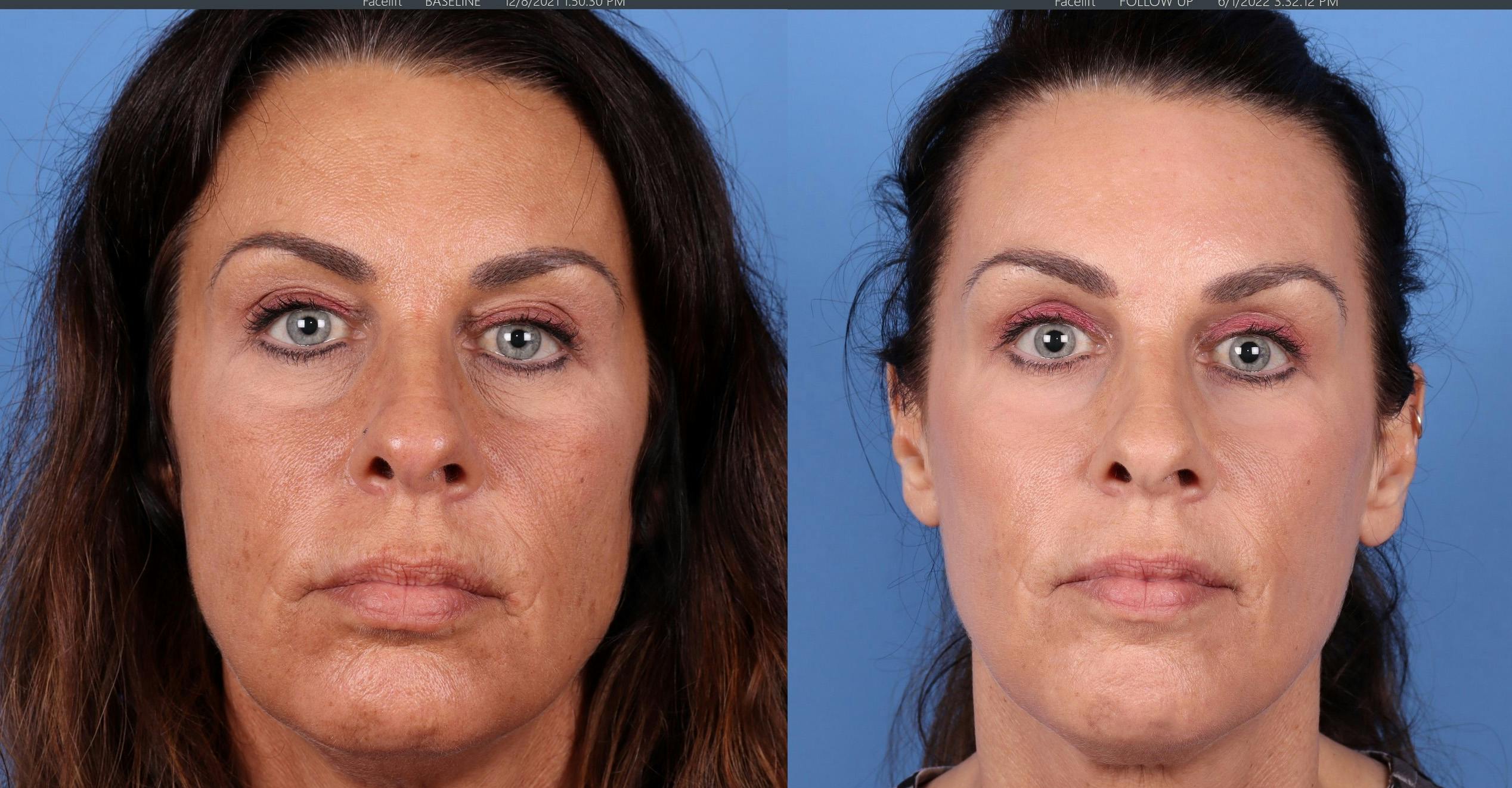 Eyelid Surgery (Blepharoplasty) Before & After Gallery - Patient 122008725 - Image 1