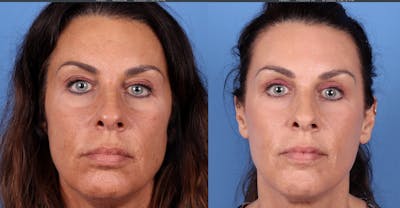 Eyelid Surgery (Upper Blepharoplasty) Before & After Gallery - Patient 122008725 - Image 1