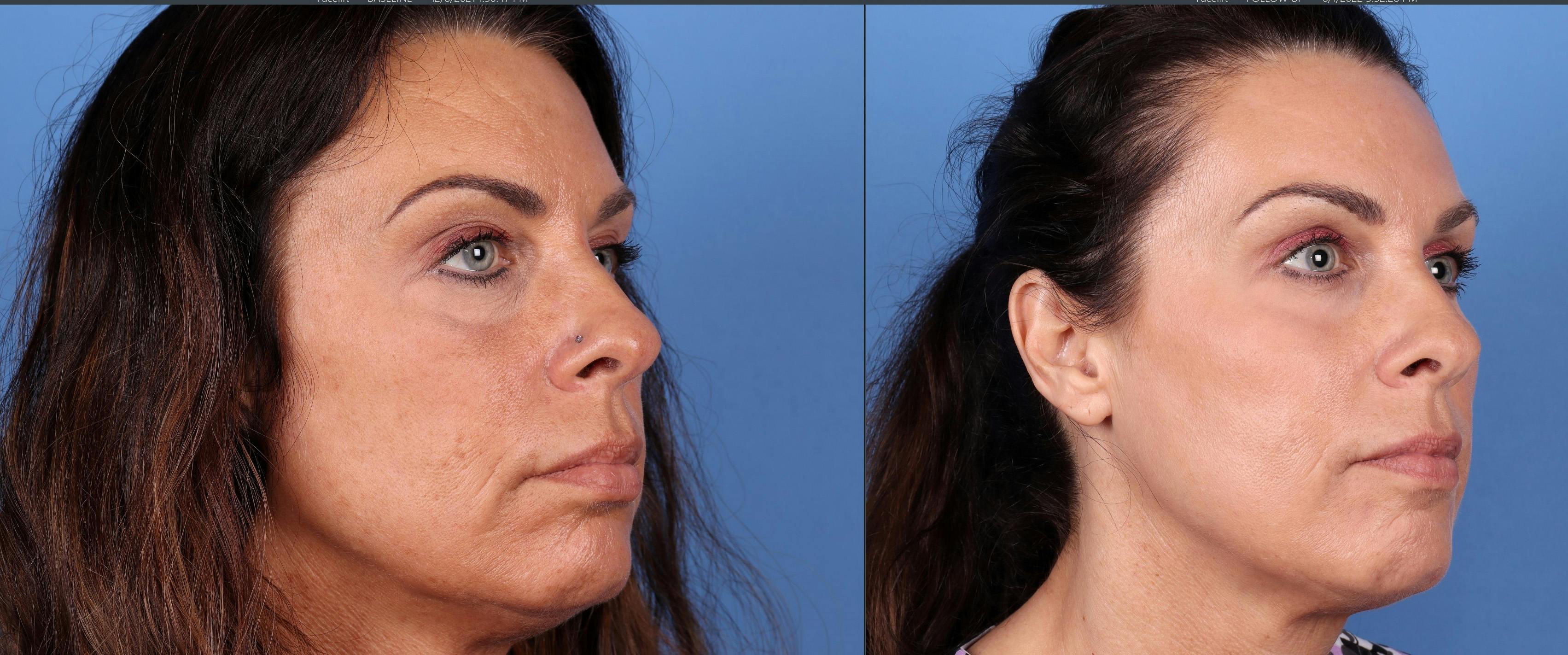 Eyelid Surgery (Upper Blepharoplasty) Before & After Gallery - Patient 122008725 - Image 2