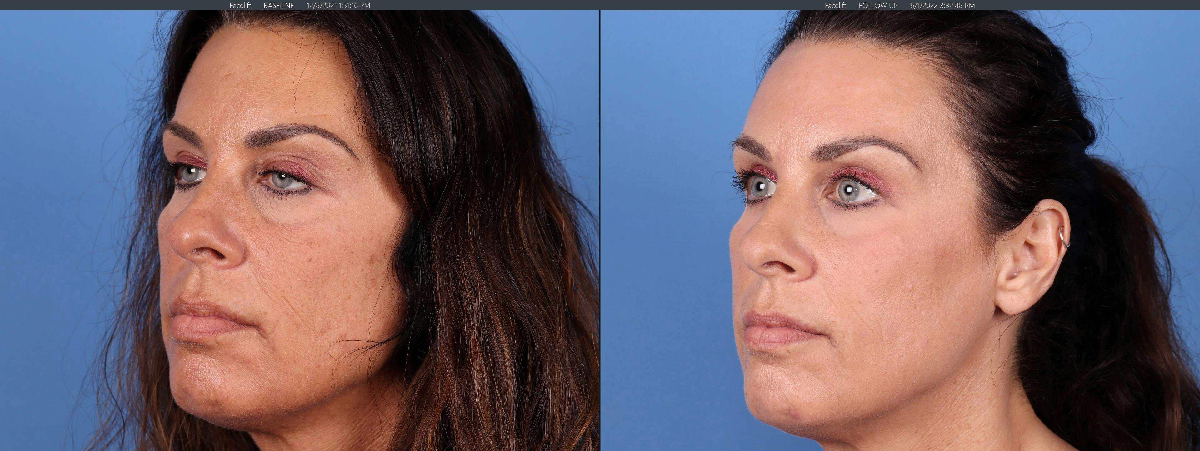 Eyelid Surgery (Upper Blepharoplasty) Before & After Gallery - Patient 122008725 - Image 4