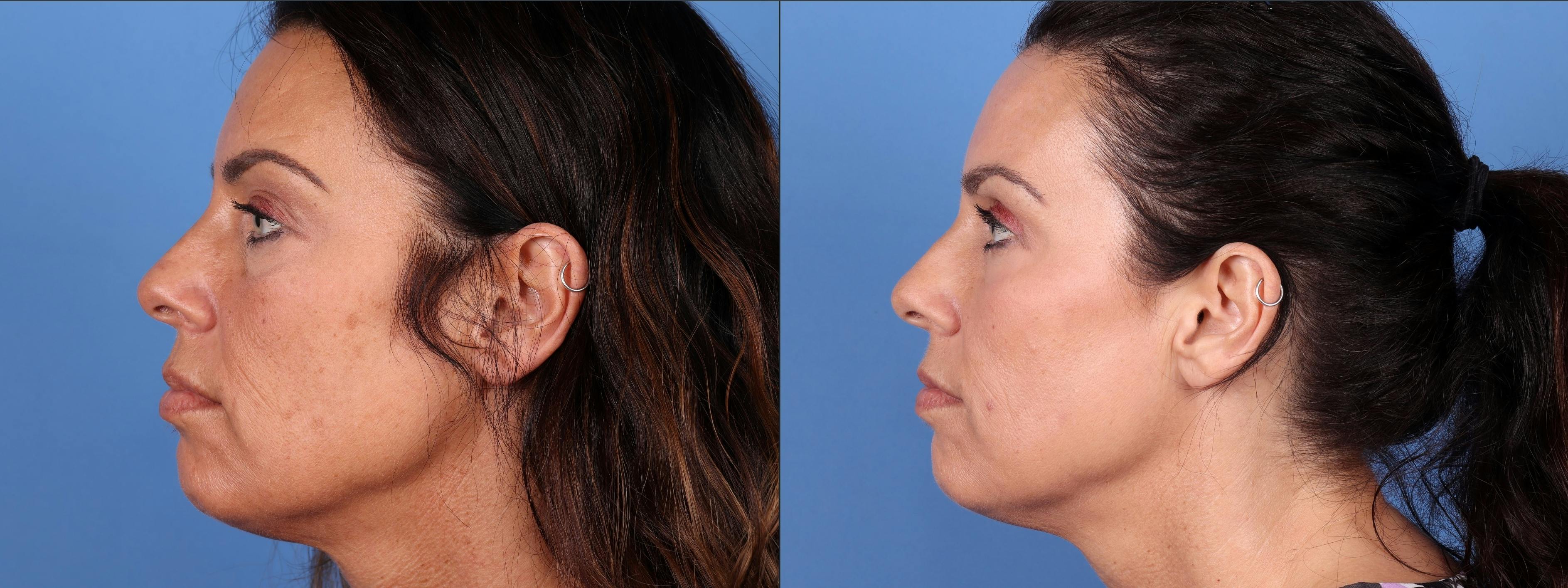 Eyelid Surgery (Upper Blepharoplasty) Before & After Gallery - Patient 122008725 - Image 5