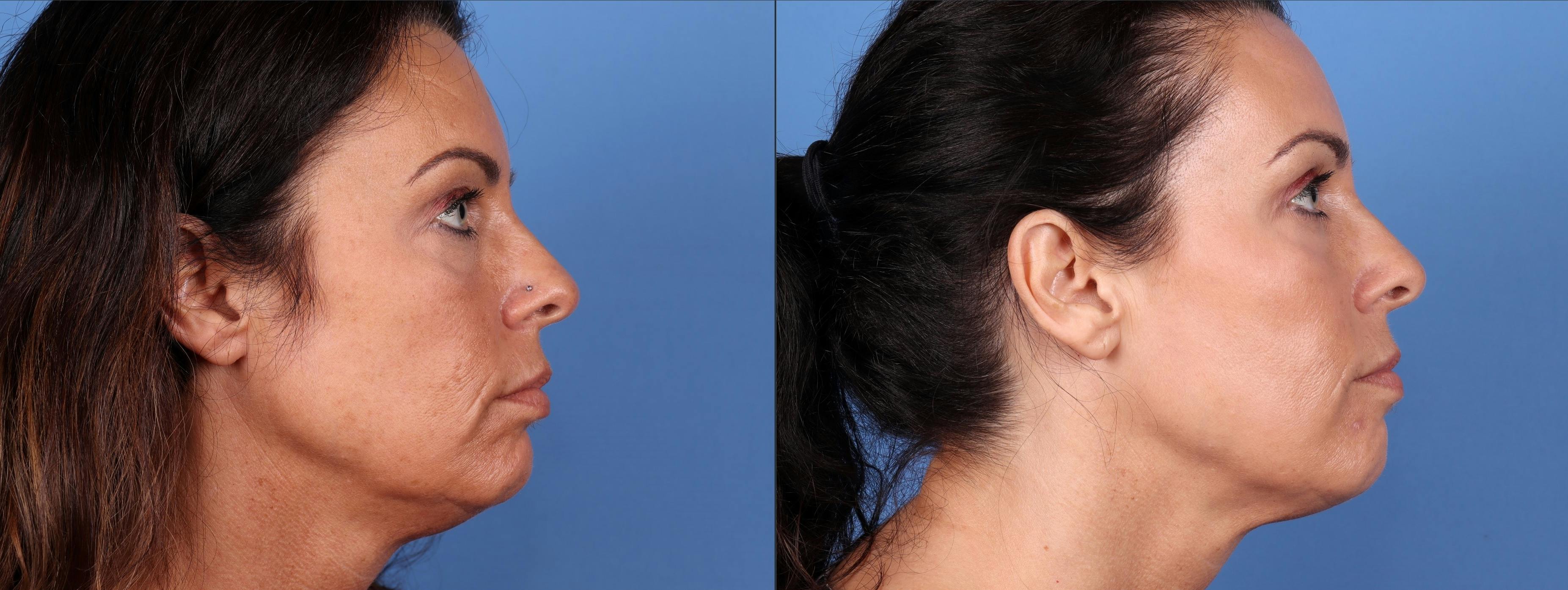 Eyelid Surgery (Upper Blepharoplasty) Before & After Gallery - Patient 122008725 - Image 3