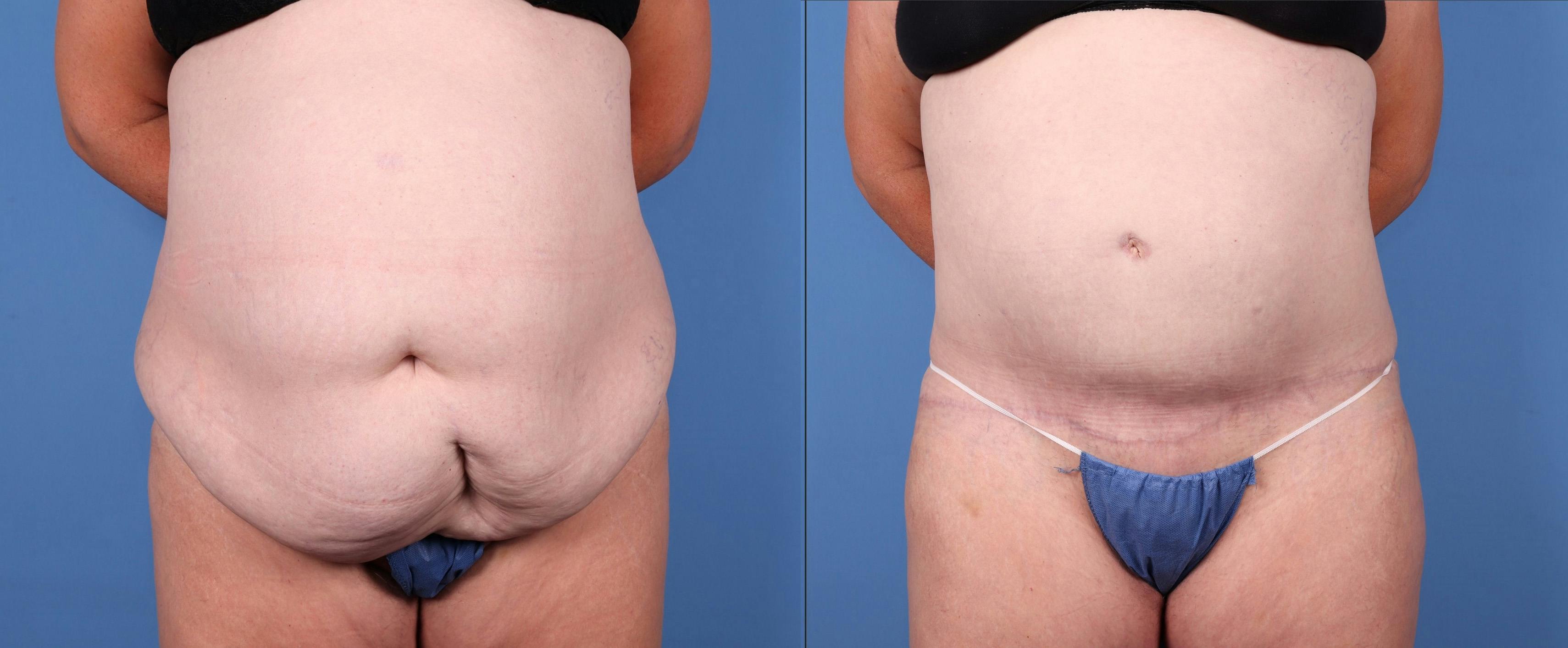 Tummy Tuck Before & After Gallery - Patient 122053899 - Image 1
