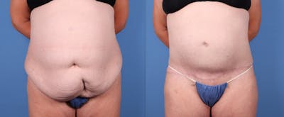 Tummy Tuck Before & After Gallery - Patient 122053899 - Image 1