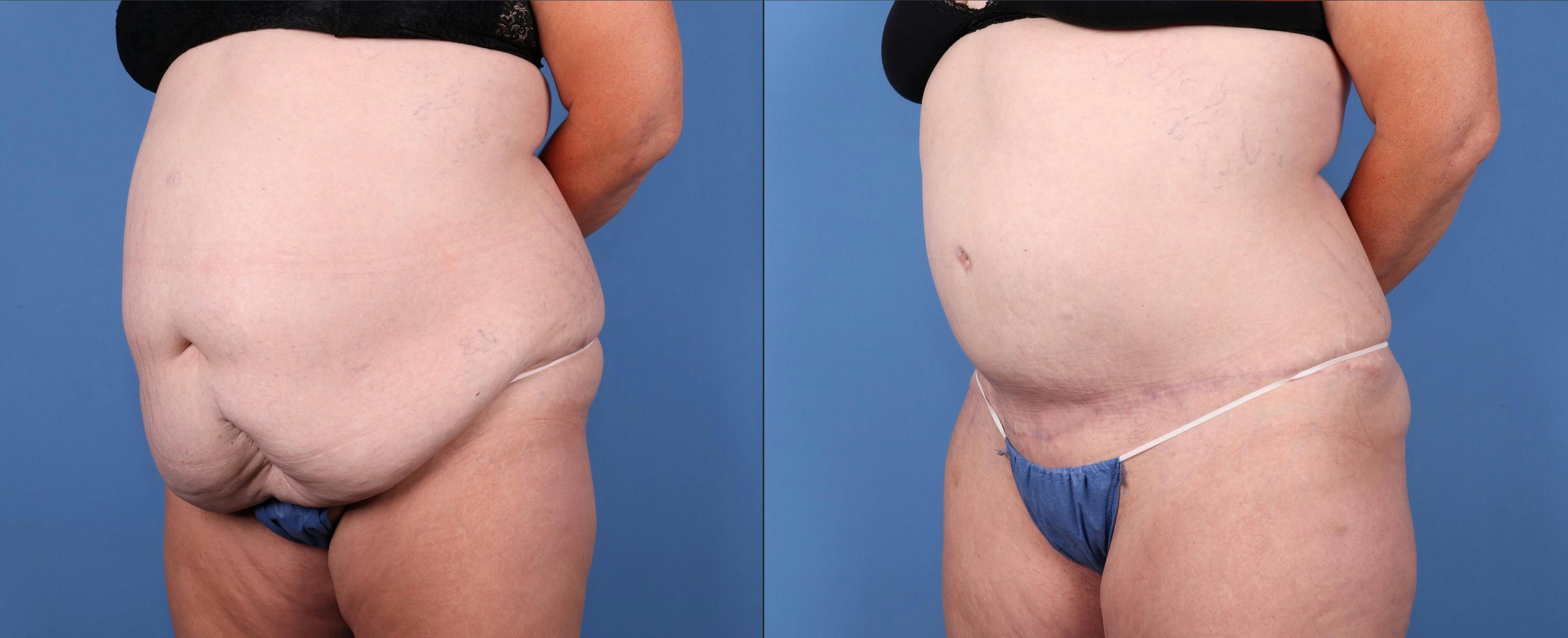 Liposuction Before & After Gallery - Patient 122053912 - Image 2