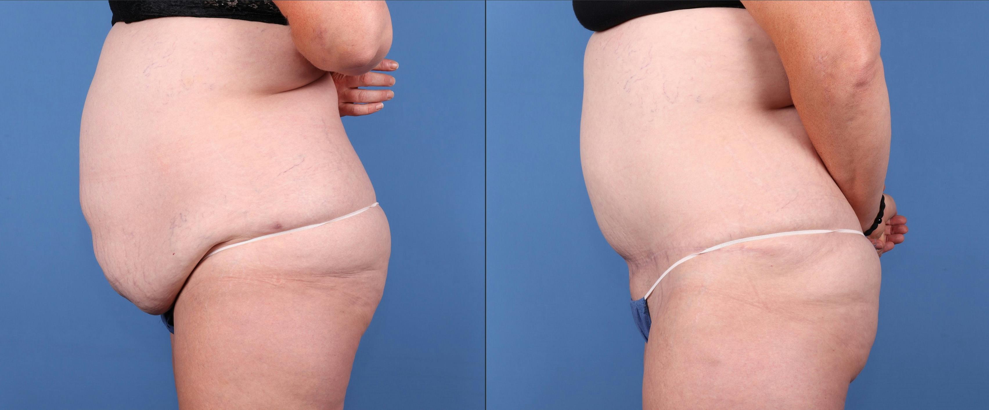 Liposuction Before & After Gallery - Patient 122053912 - Image 3