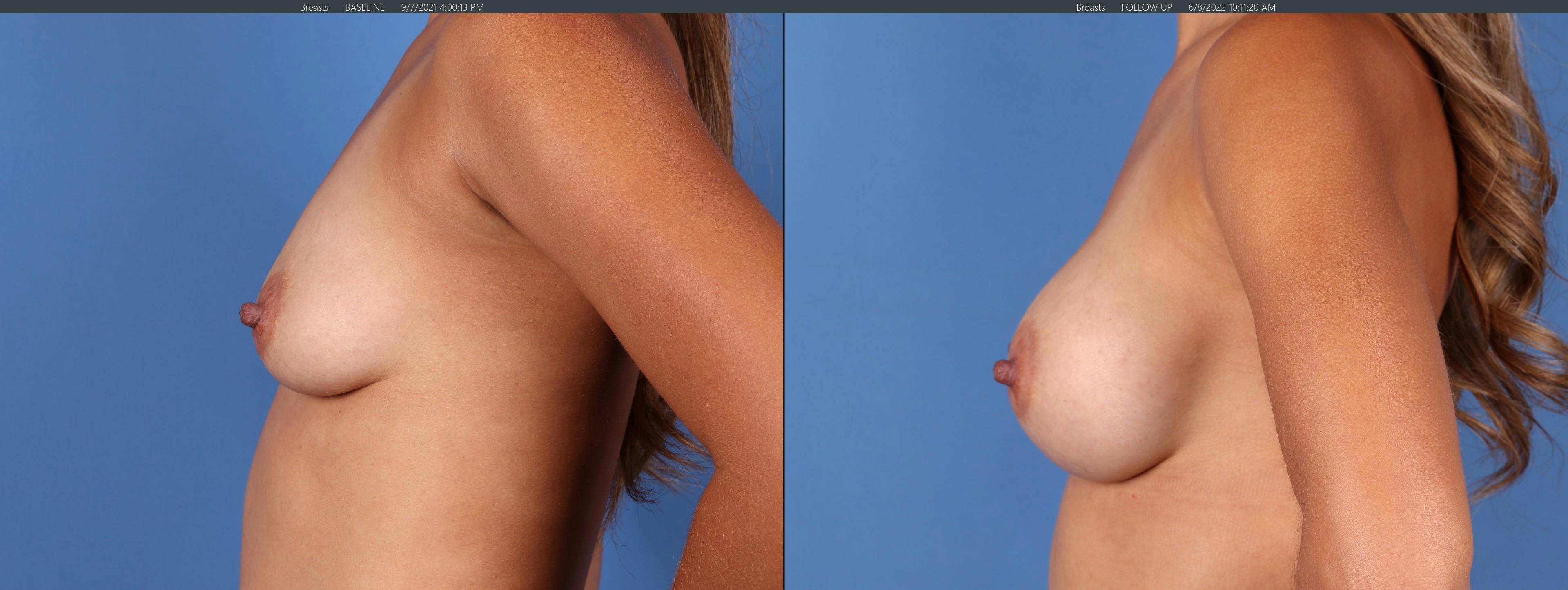 Breast Augmentation Before & After Gallery - Patient 122126848 - Image 5