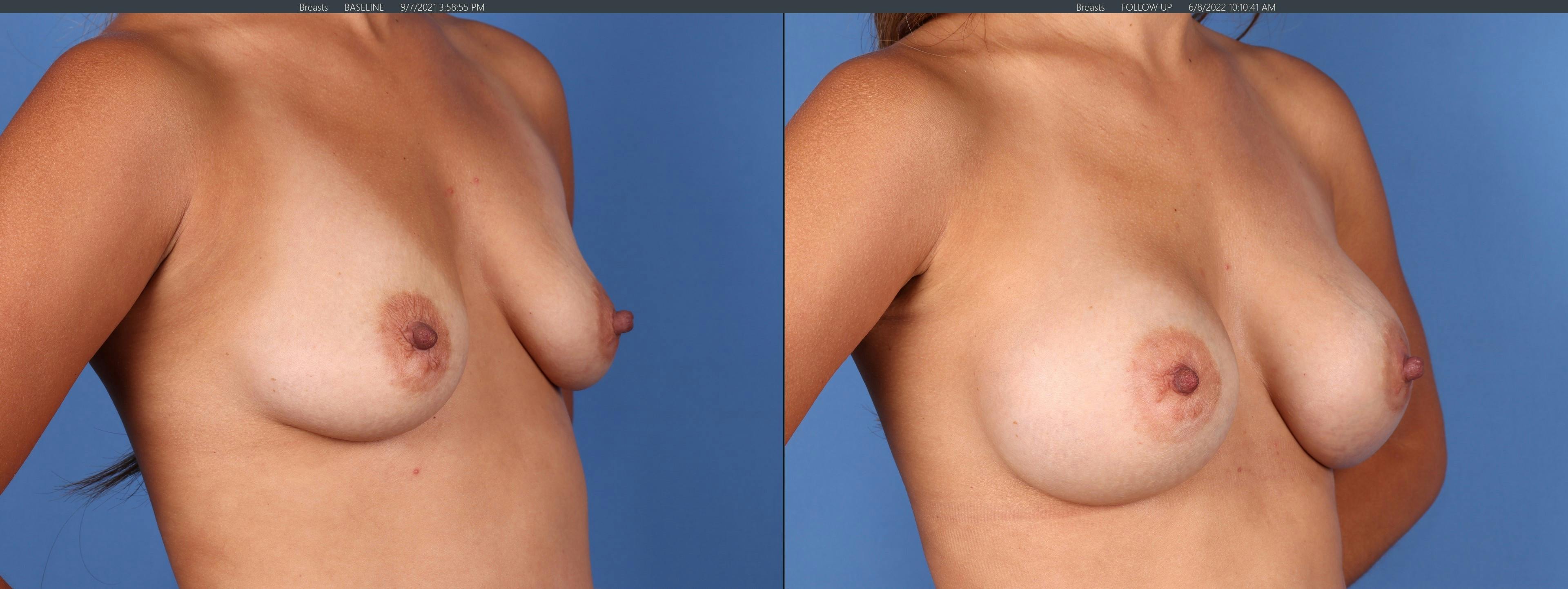 Breast Augmentation Before & After Gallery - Patient 122126848 - Image 2