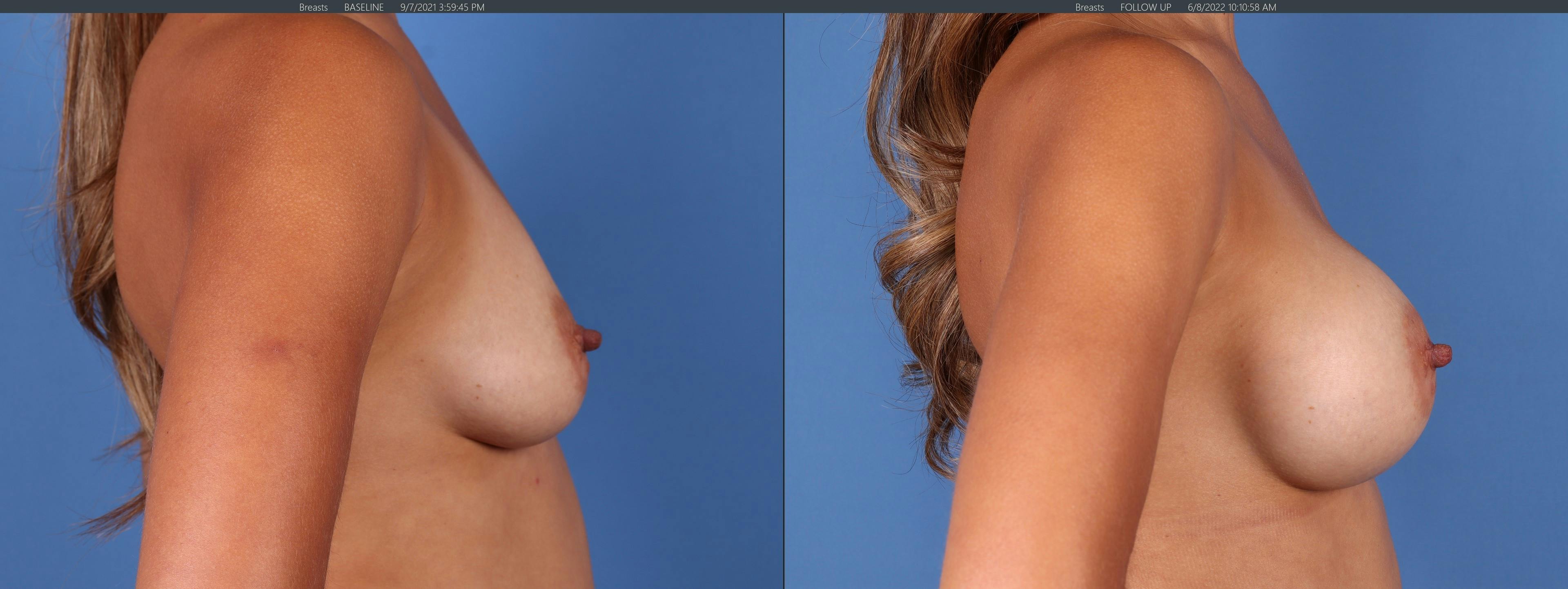 Breast Augmentation Gallery - Patient 122126848 - Image 3