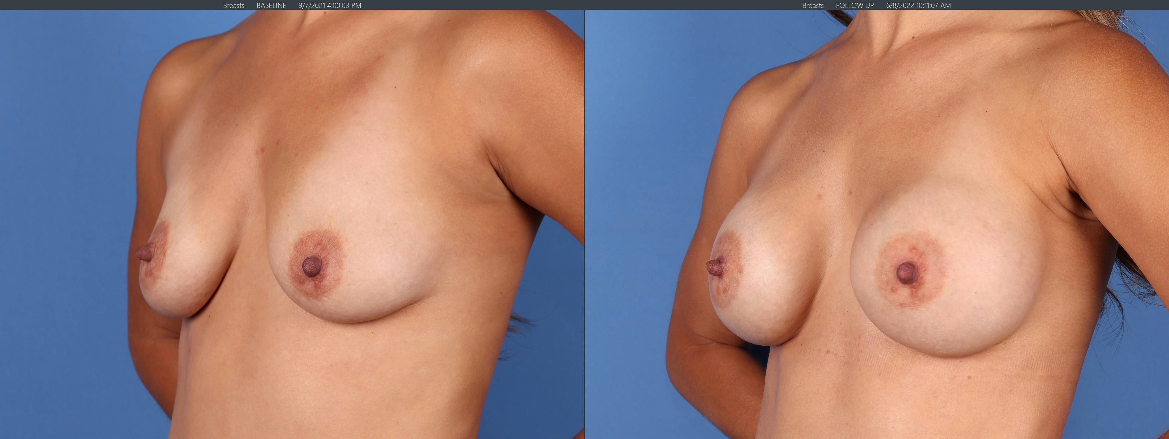 Breast Augmentation Before & After Gallery - Patient 122126848 - Image 4
