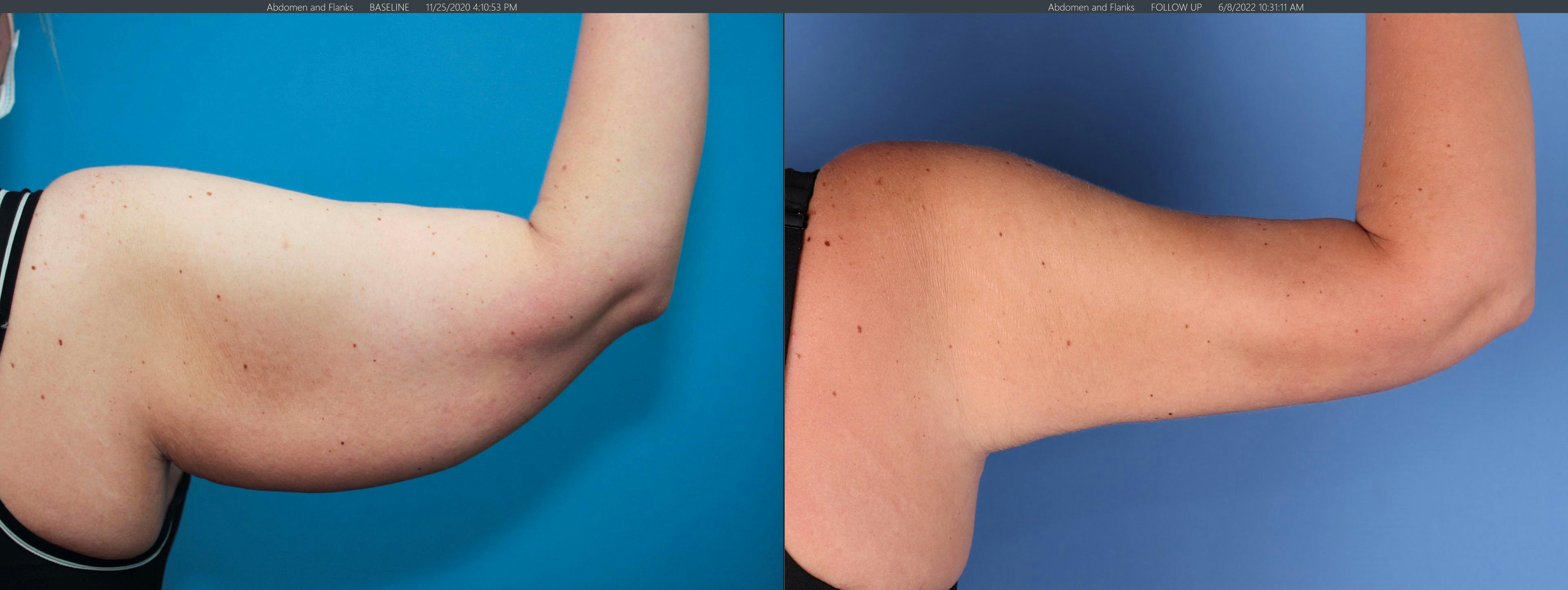 Arms Before & After Gallery - Patient 149385356 - Image 1