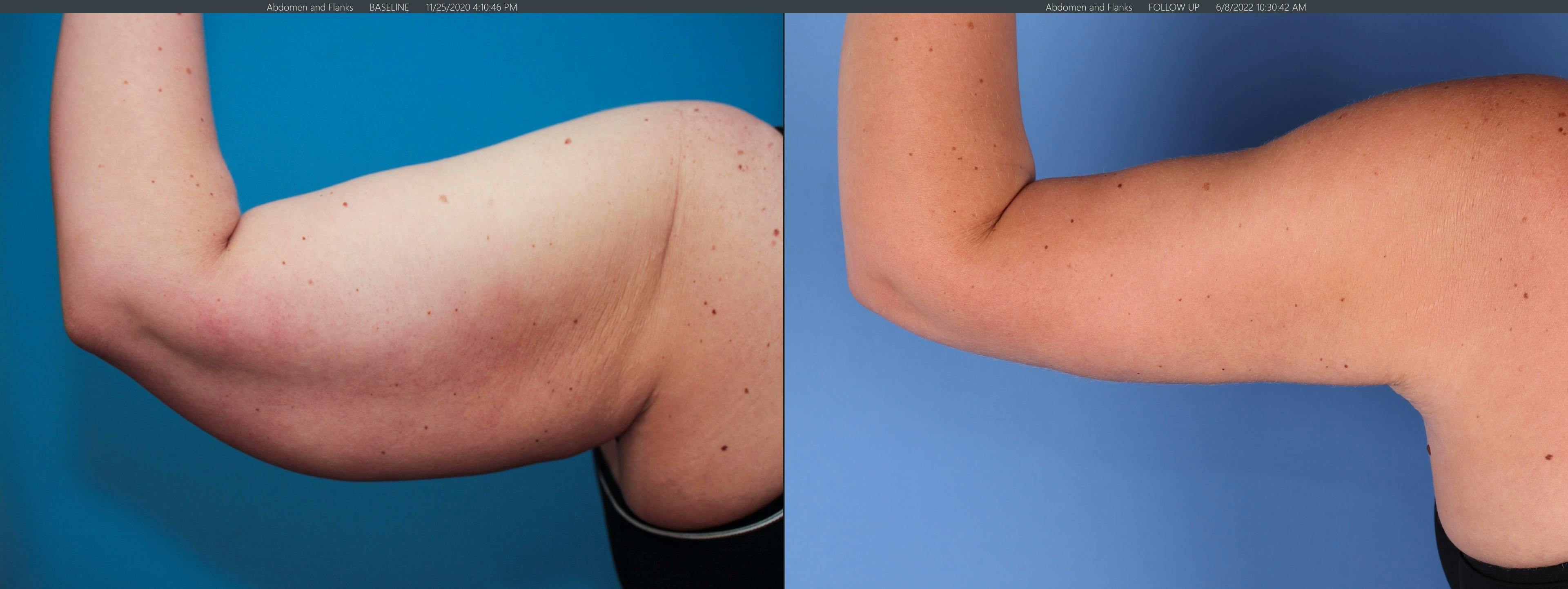Arms Before & After Gallery - Patient 149385356 - Image 2