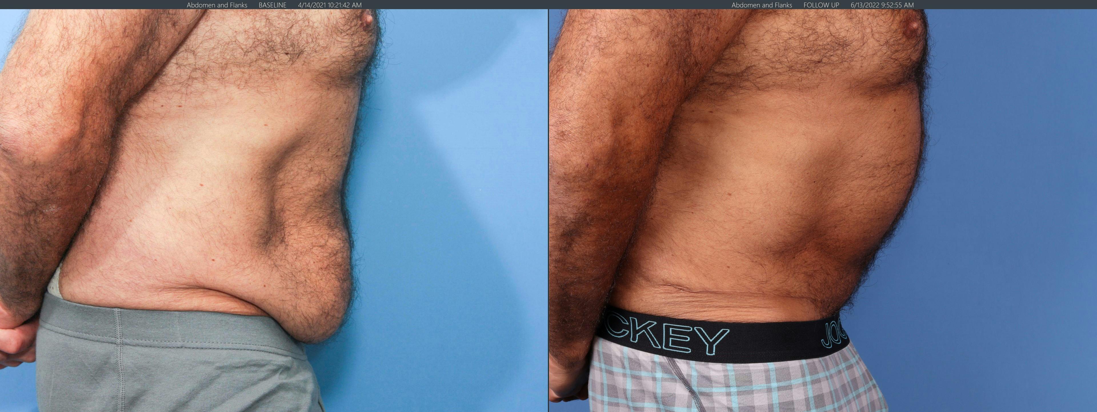 Tummy Tuck Before & After Gallery - Patient 122226996 - Image 2