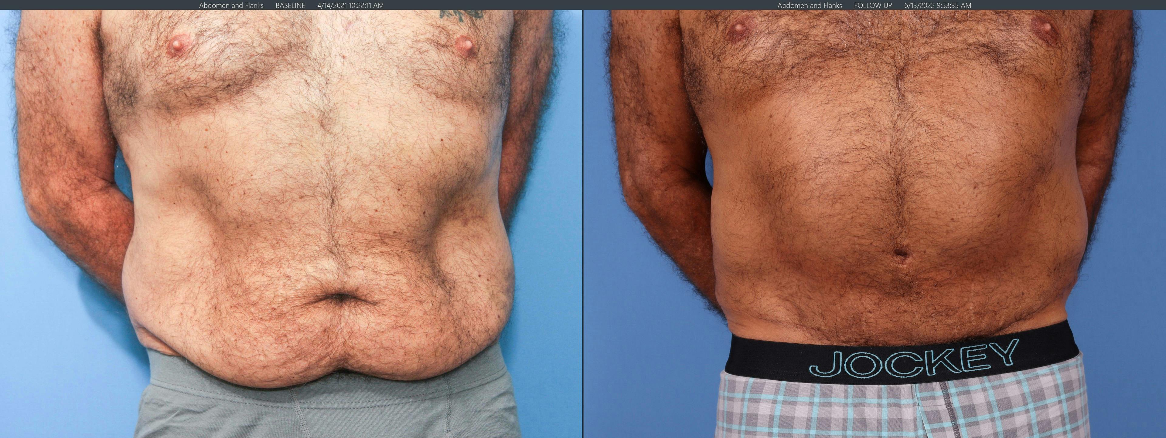 Tummy Tuck Before & After Gallery - Patient 122226996 - Image 1