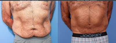 Tummy Tuck Before & After Gallery - Patient 122226996 - Image 1