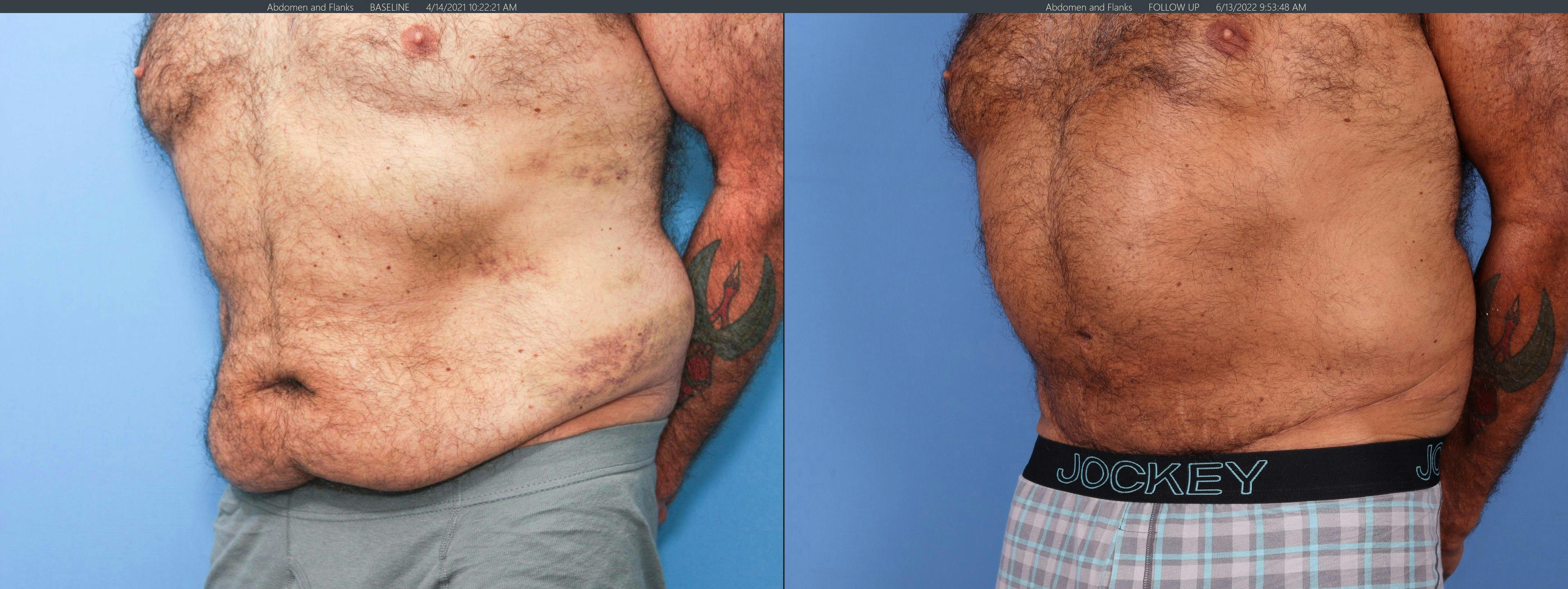 Tummy Tuck Before & After Gallery - Patient 122226996 - Image 3