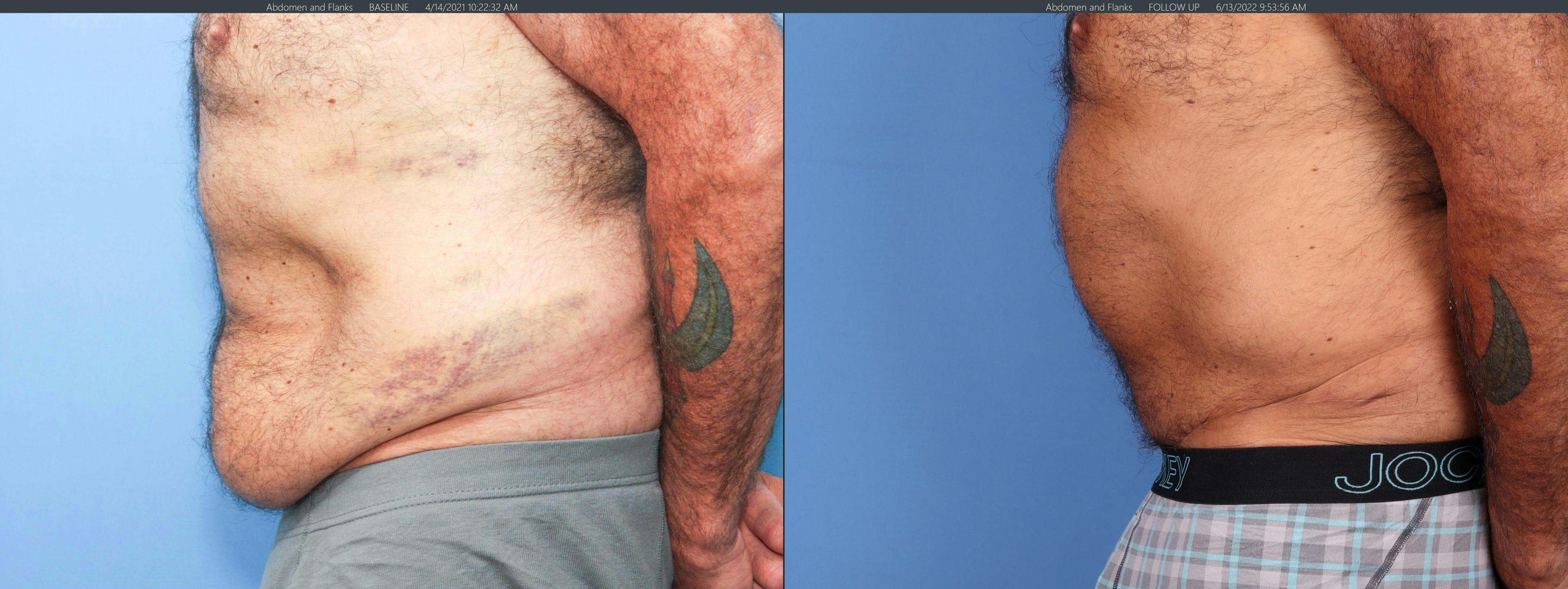 Tummy Tuck Before & After Gallery - Patient 122226996 - Image 4