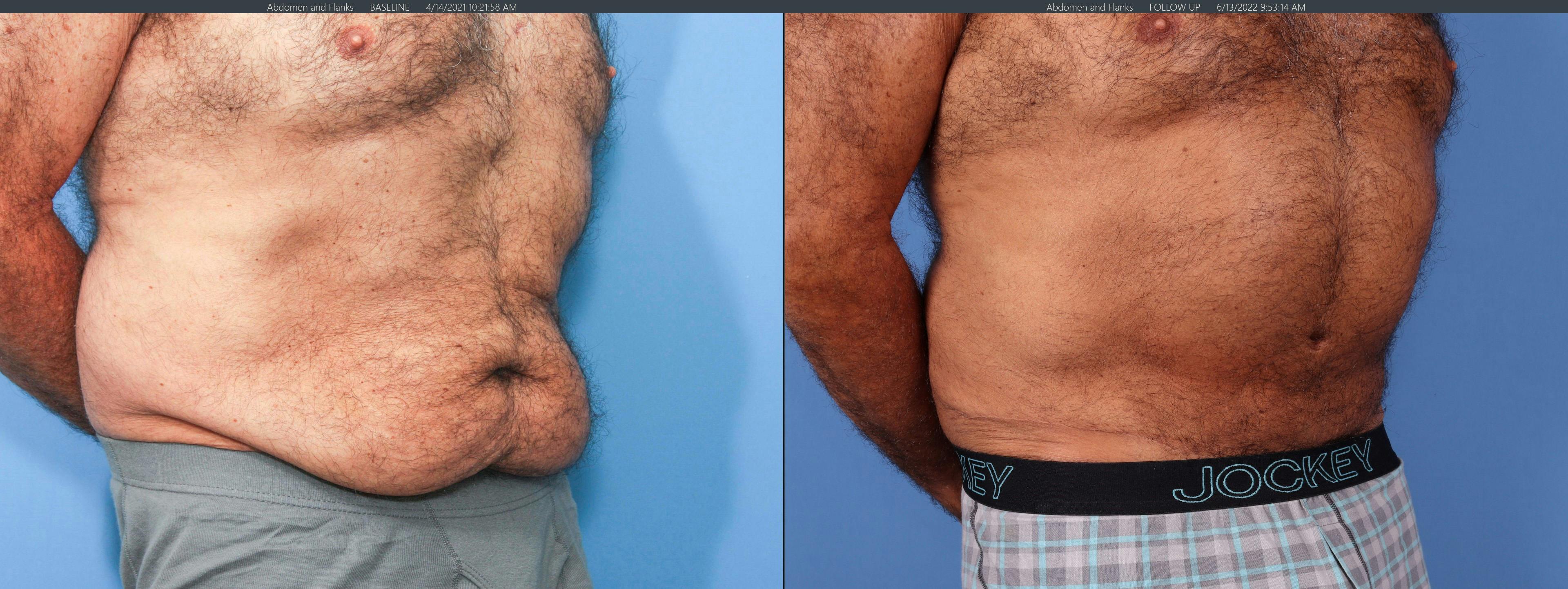 Tummy Tuck Gallery - Patient 122226996 - Image 5
