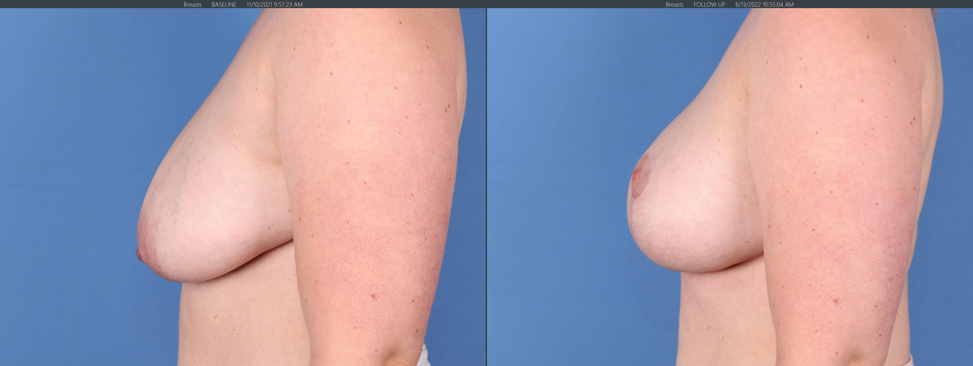 Breast Lift Before & After Gallery - Patient 122227034 - Image 5