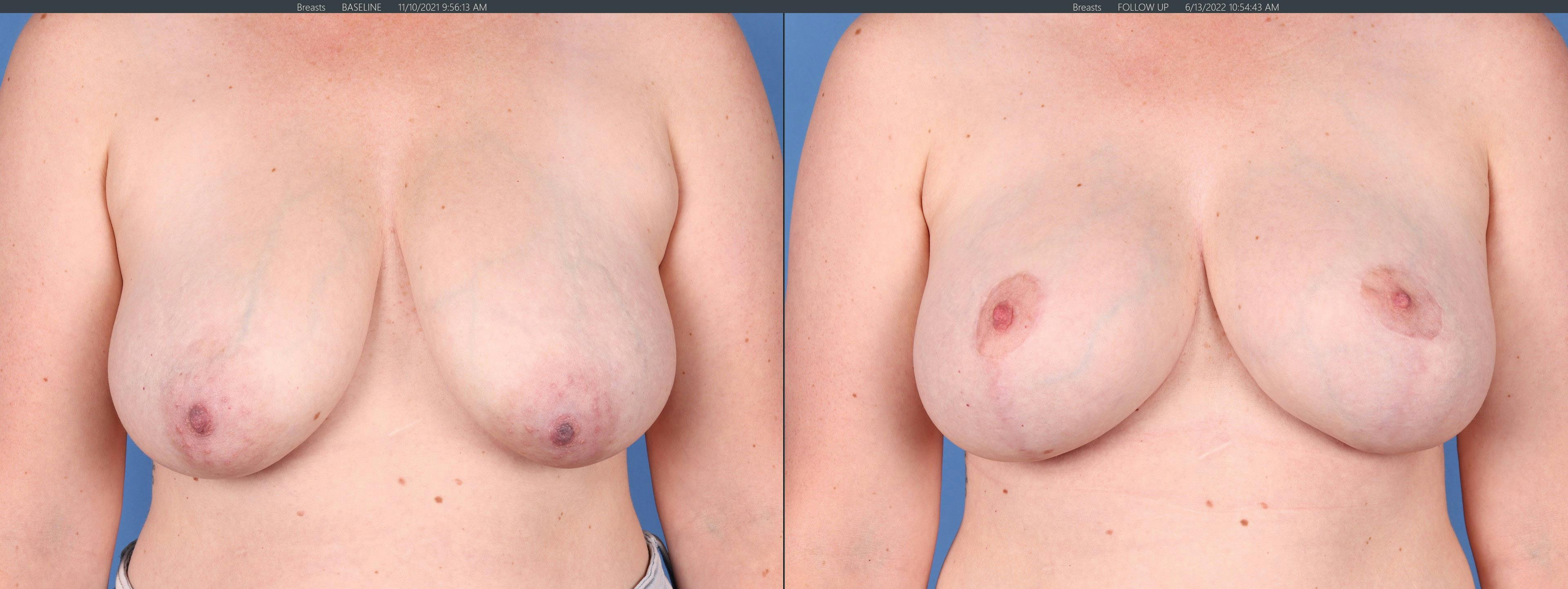 Breast Lift Gallery - Patient 122227034 - Image 1