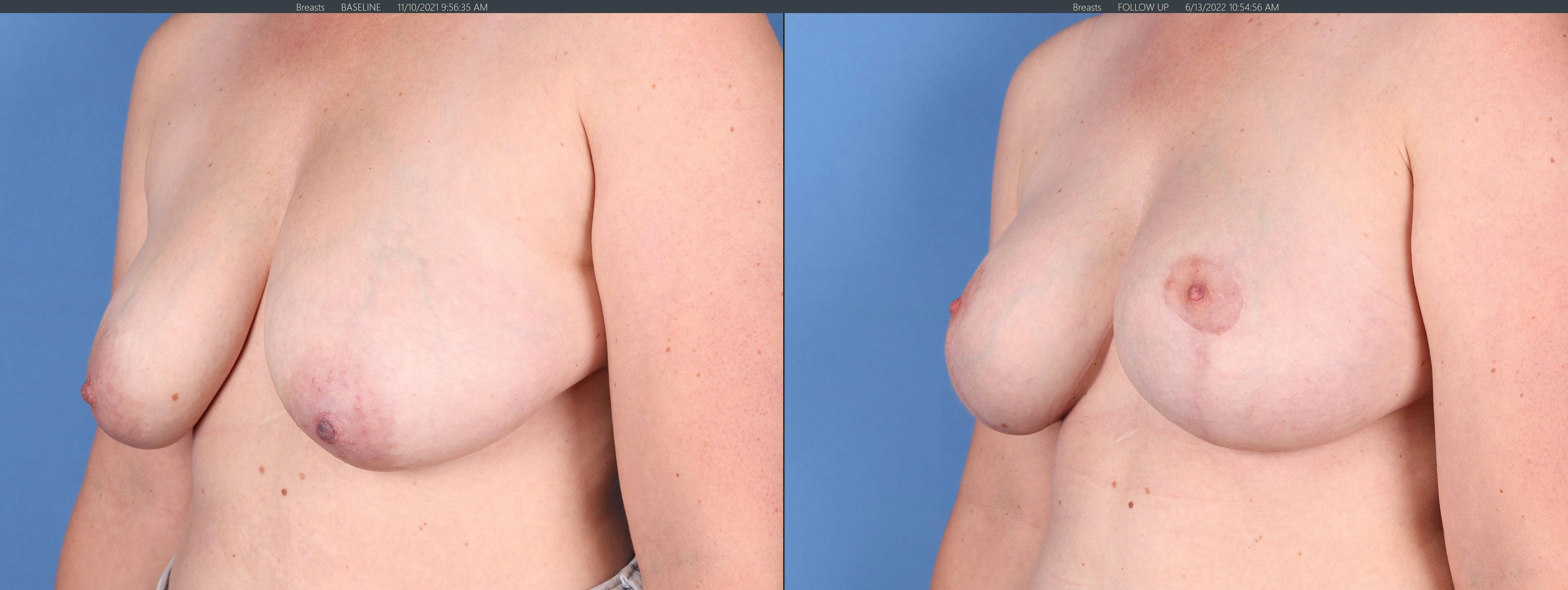 Breast Lift Before & After Gallery - Patient 122227034 - Image 4