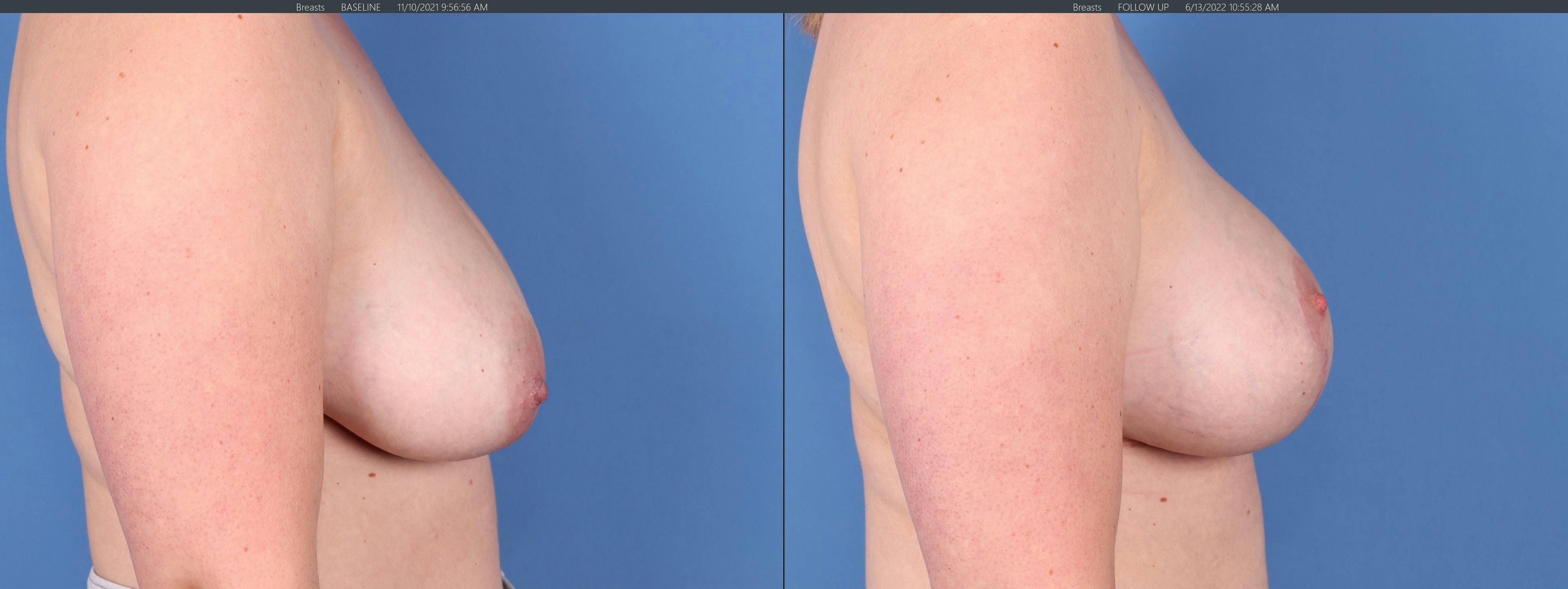 Breast Lift Before & After Gallery - Patient 122227034 - Image 3