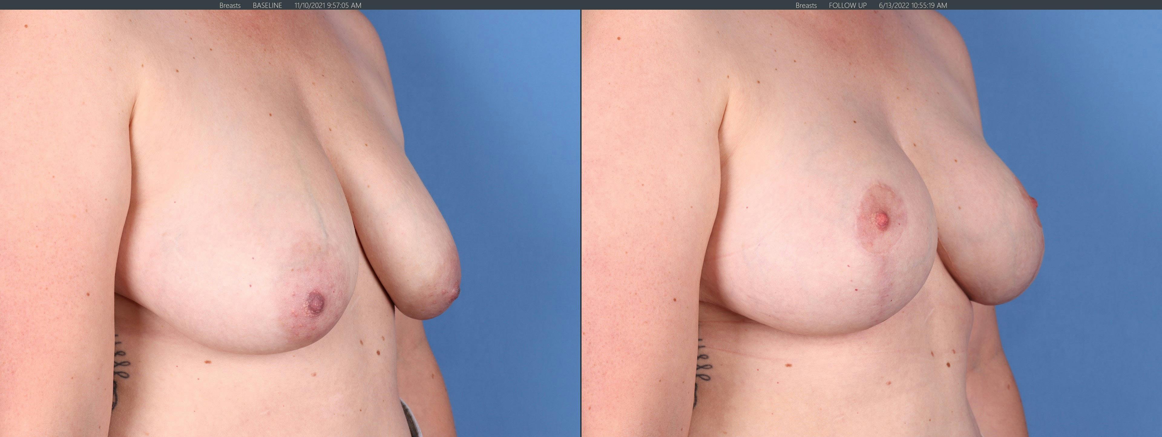 Breast Lift Before & After Gallery - Patient 122227034 - Image 2