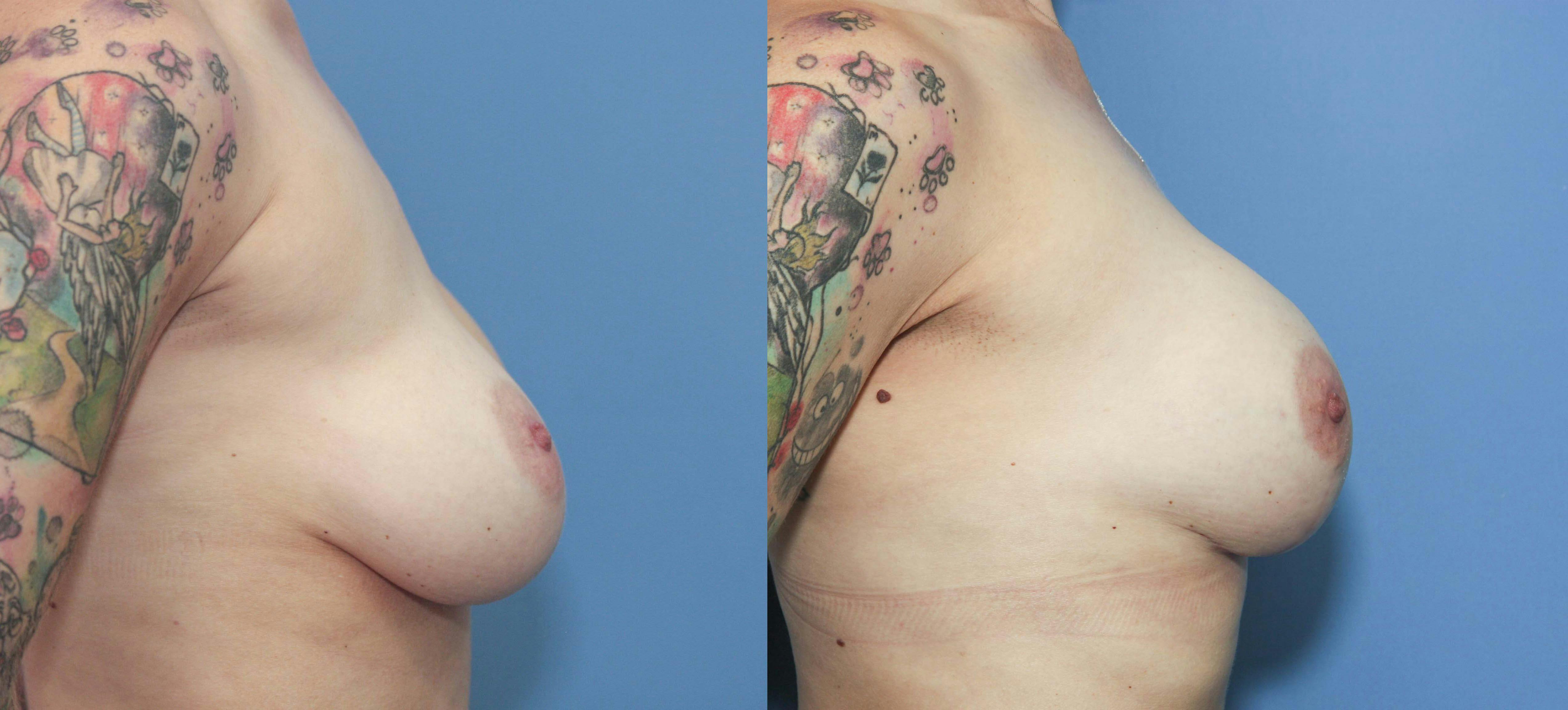 Breast Revision Before & After Gallery - Patient 122392869 - Image 2
