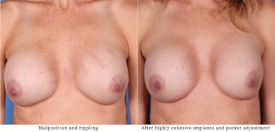 Breast Revision Before & After Gallery - Patient 122392901 - Image 1