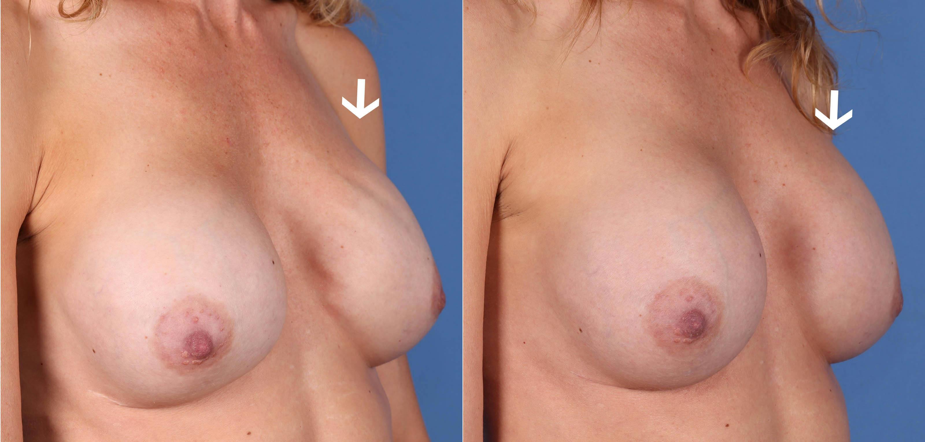 Breast Revision Before & After Gallery - Patient 122392901 - Image 2