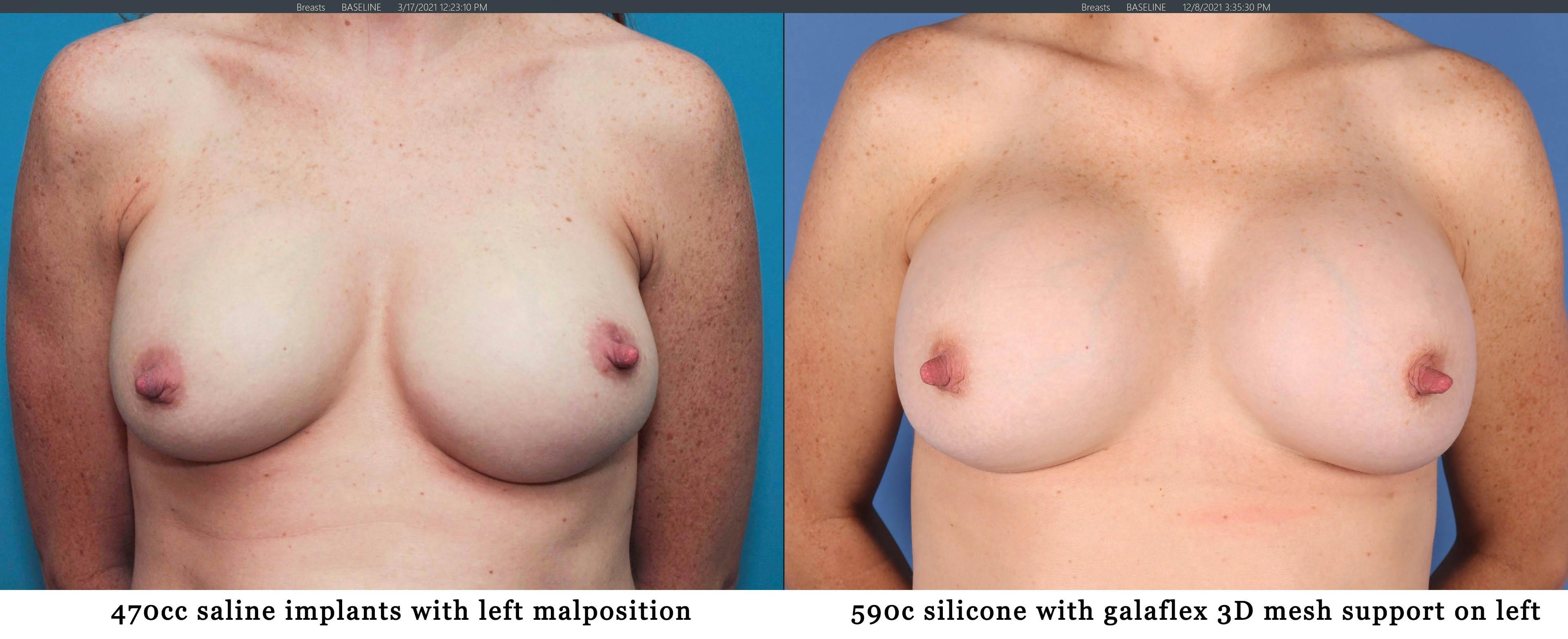 Breast Implant Revision Before & After Gallery - Patient 122393077 - Image 1