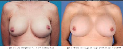 Breast Revision Before & After Gallery - Patient 122393077 - Image 1