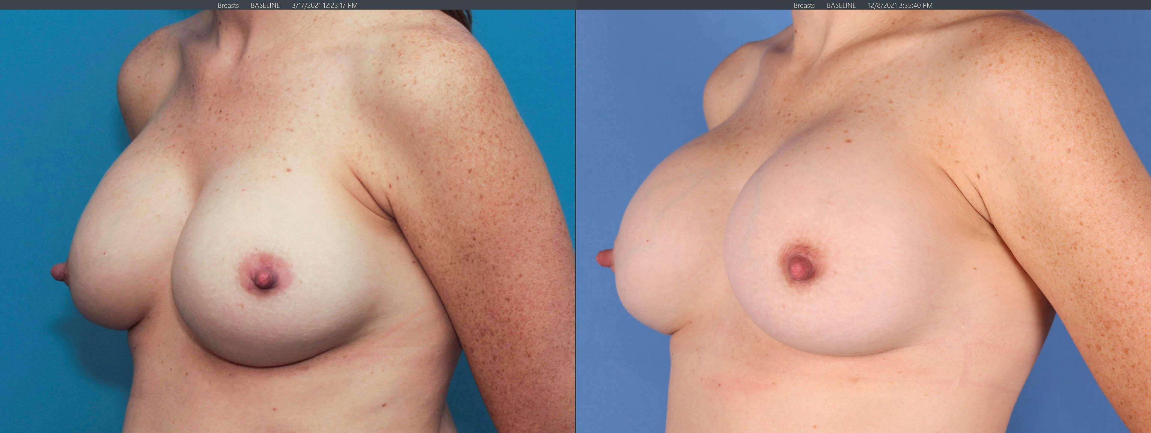 Breast Revision Before & After Gallery - Patient 122393077 - Image 2