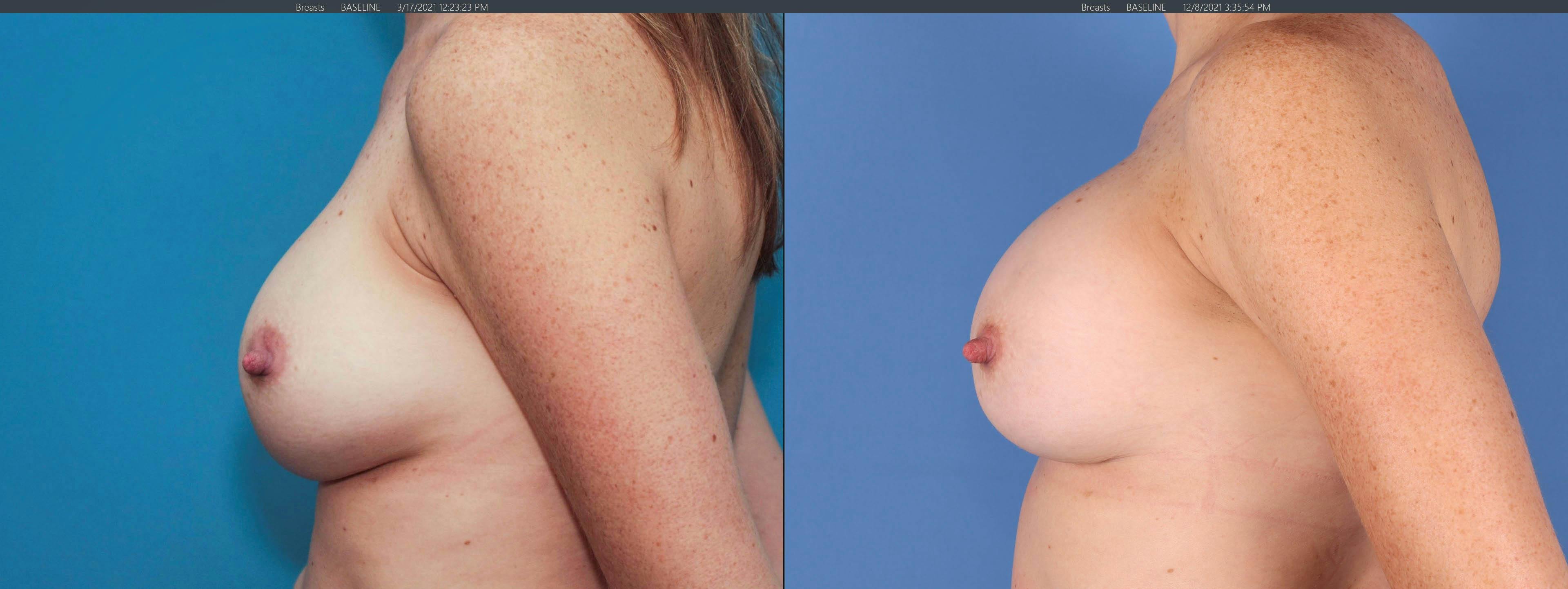 Breast Implant Revision Before & After Gallery - Patient 122393077 - Image 3