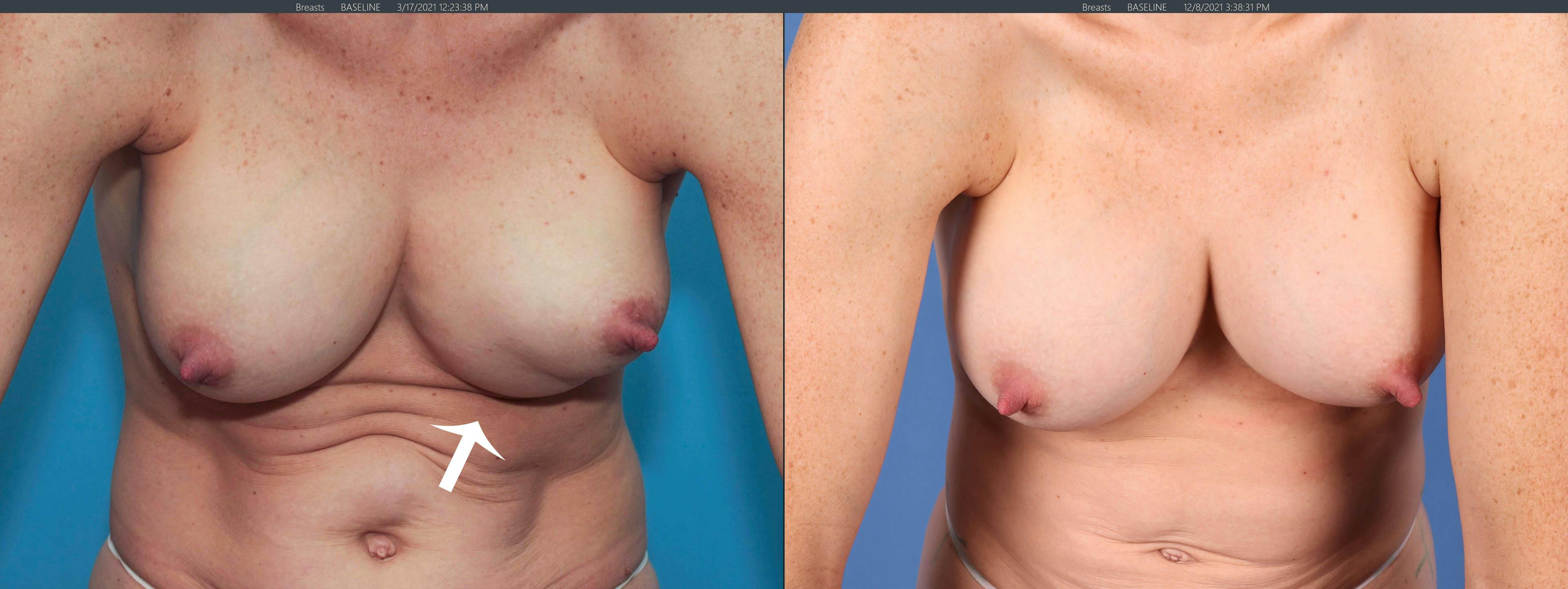 Breast Revision Before & After Gallery - Patient 122393077 - Image 4