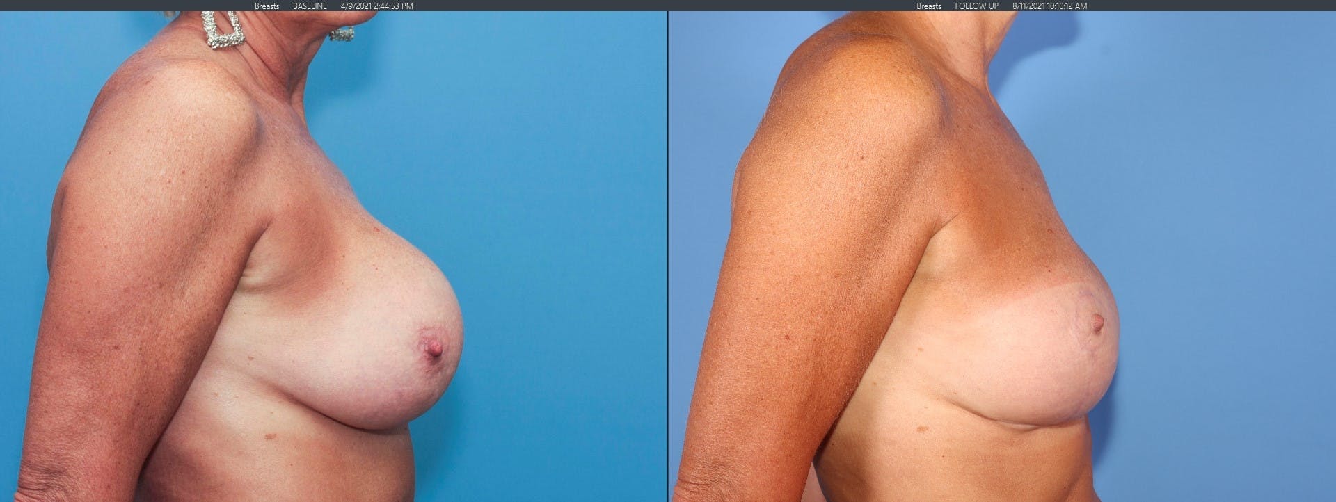 Breast Revision Before & After Gallery - Patient 122393212 - Image 3