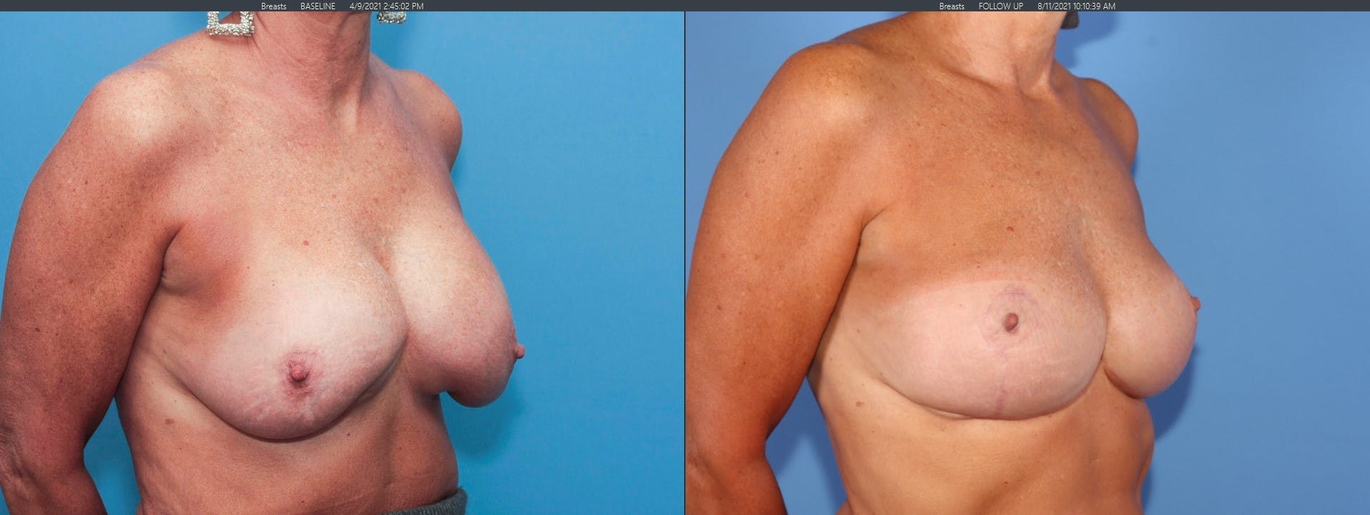 Breast Implant Revision Before & After Gallery - Patient 122393212 - Image 2