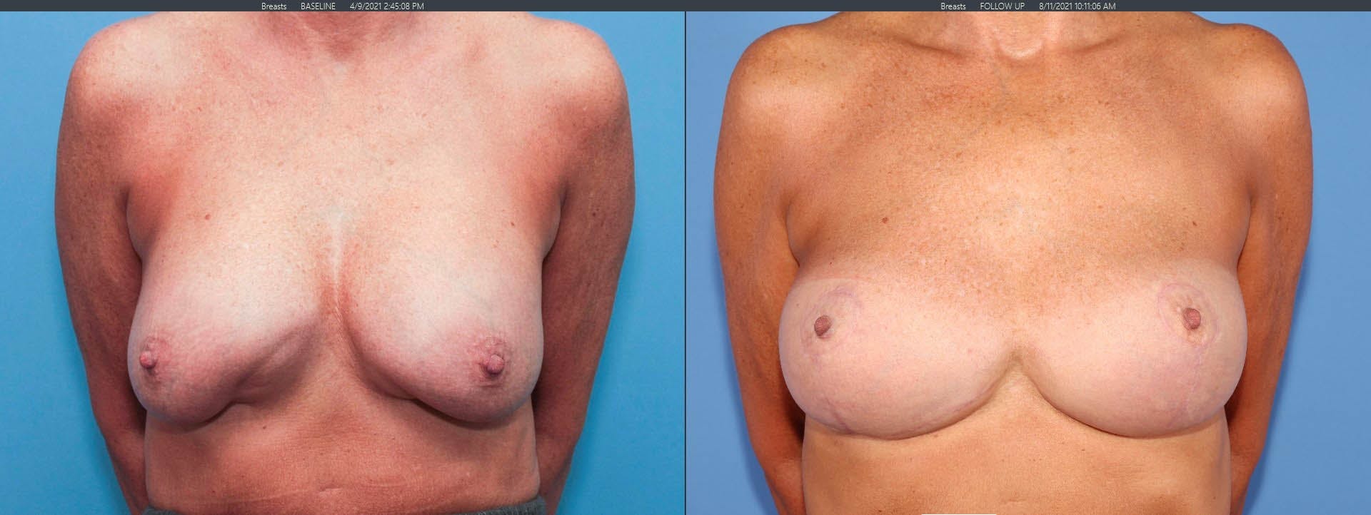Breast Revision Before & After Gallery - Patient 122393212 - Image 1