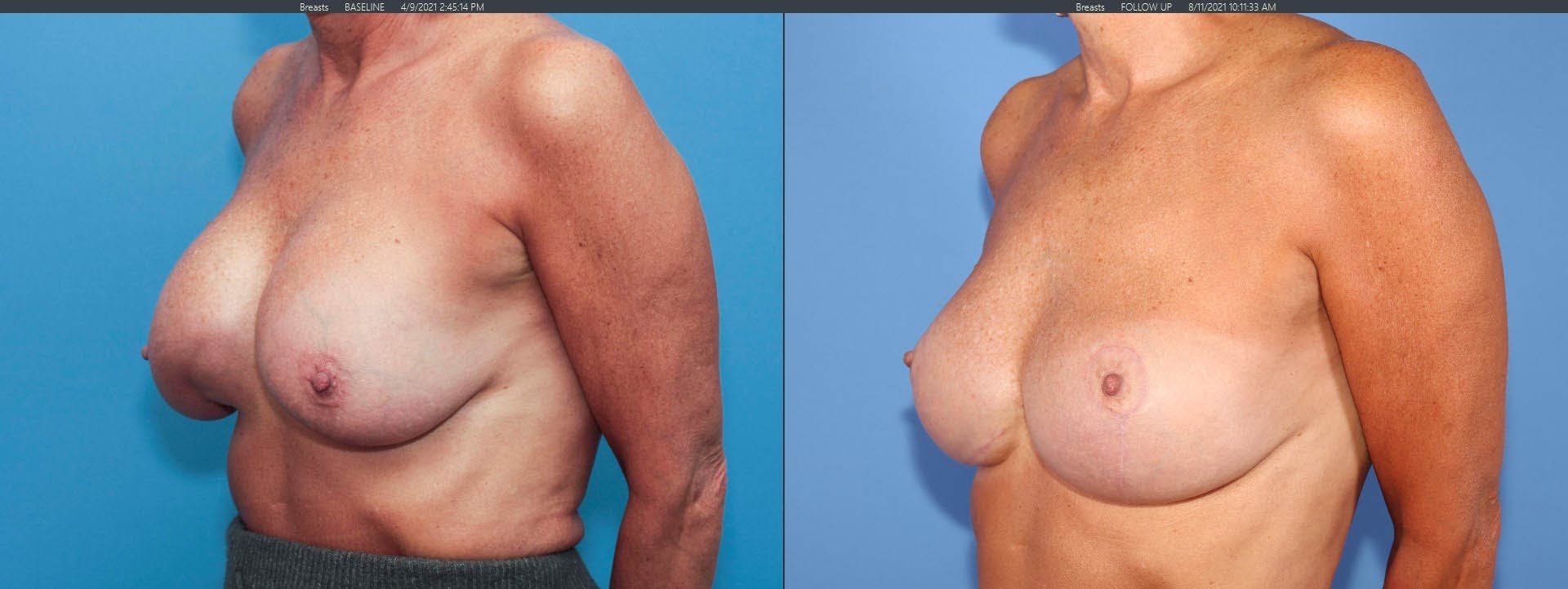 Breast Implant Revision Gallery - Patient 122393212 - Image 4