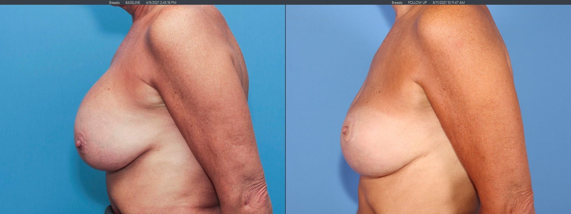 Breast Revision Before & After Gallery - Patient 122393212 - Image 5