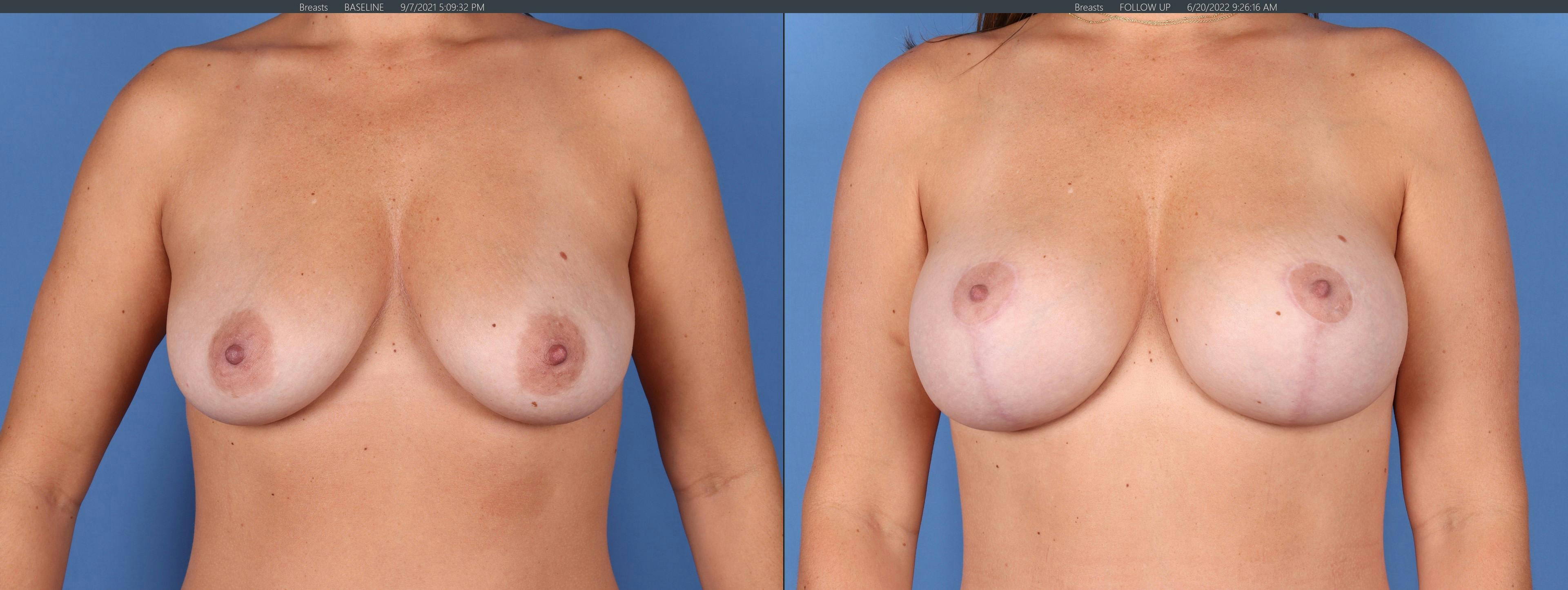 Breast Lift with Augmentation Before & After Gallery - Patient 122393331 - Image 1