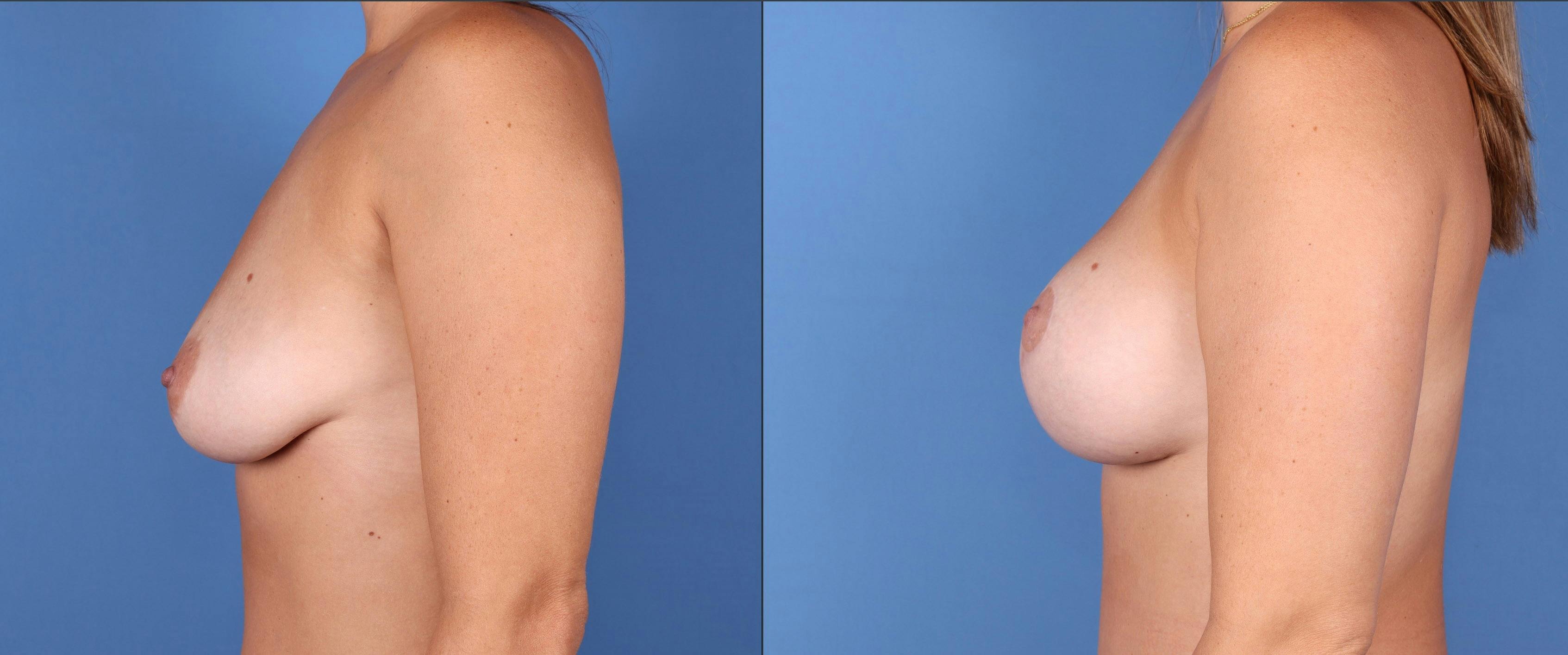 Breast Lift with Augmentation Before & After Gallery - Patient 122393331 - Image 3
