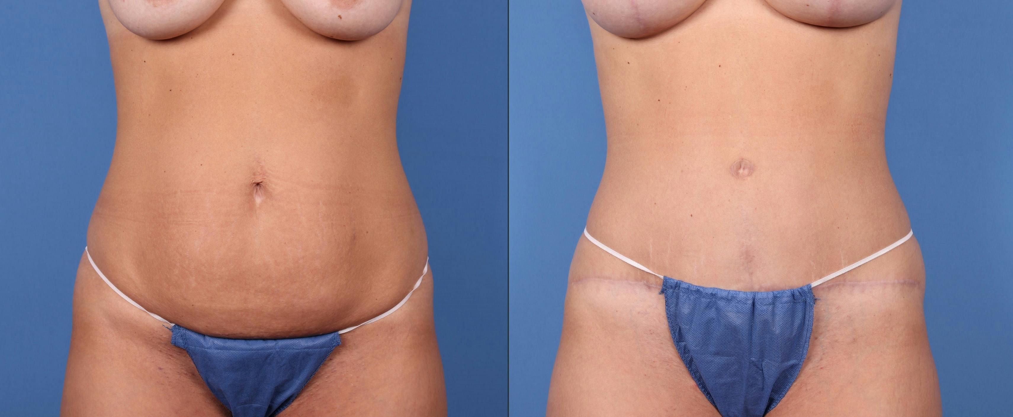 Tummy Tuck Before & After Gallery - Patient 122393352 - Image 2