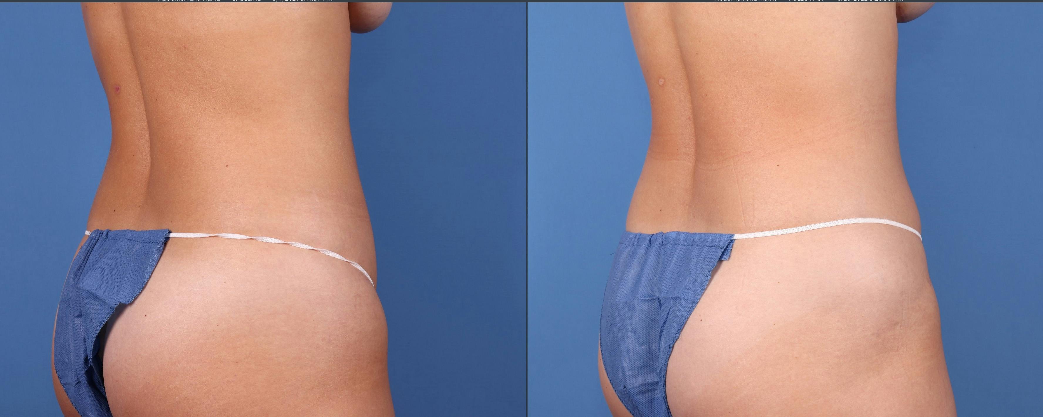 Tummy Tuck Gallery - Patient 122393352 - Image 4