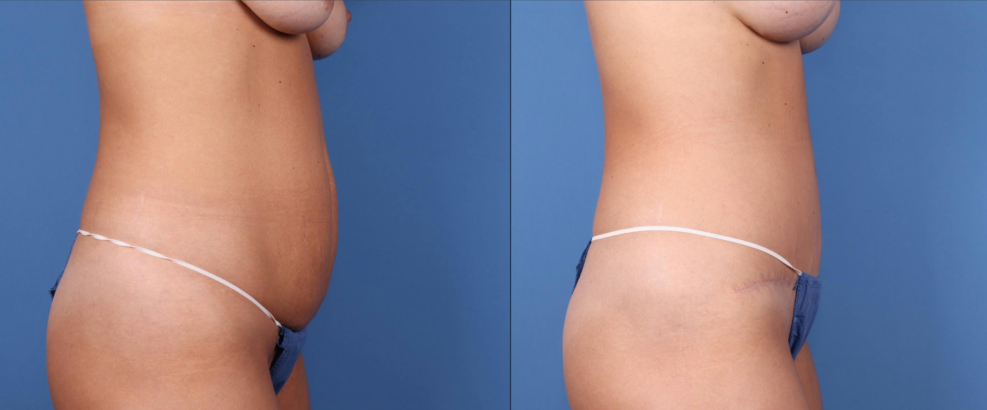 Tummy Tuck Before & After Gallery - Patient 122393352 - Image 5