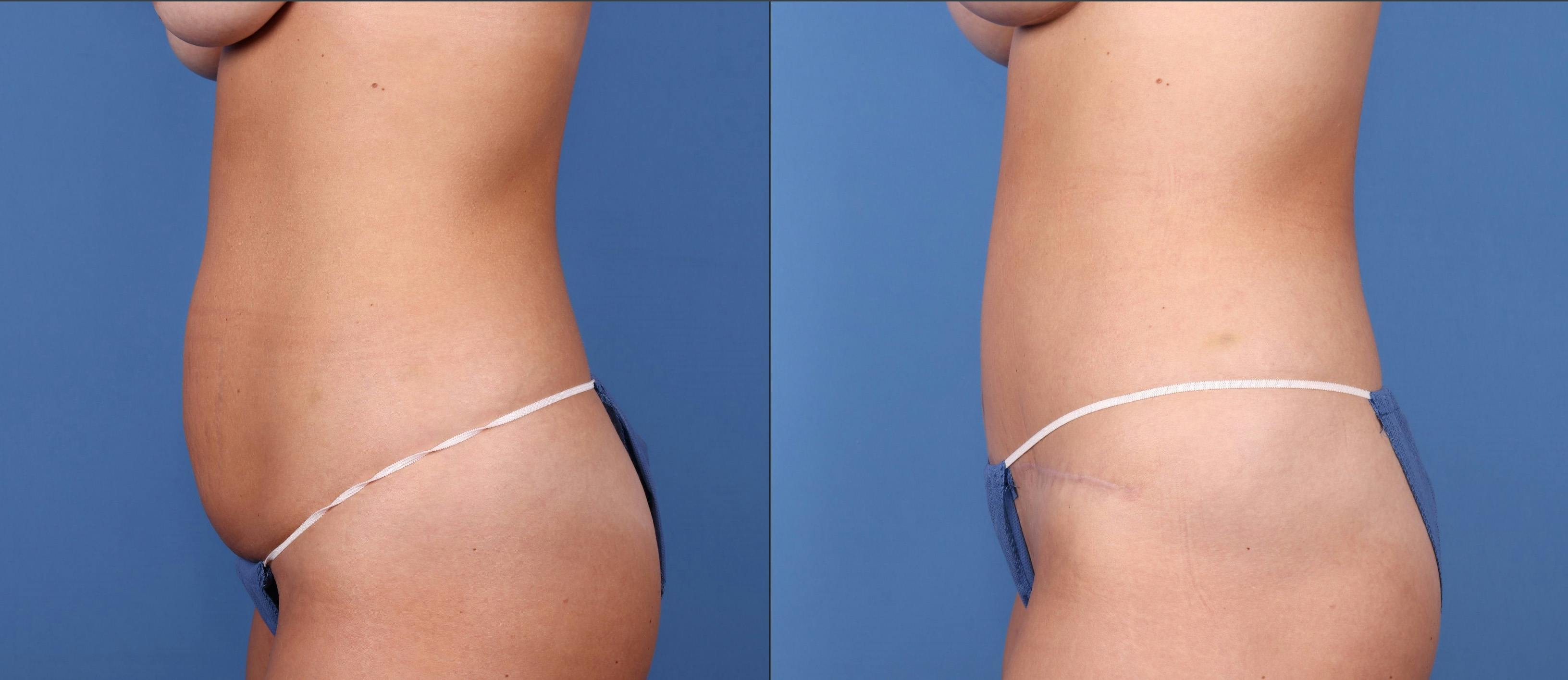 Tummy Tuck Before & After Gallery - Patient 122393352 - Image 7