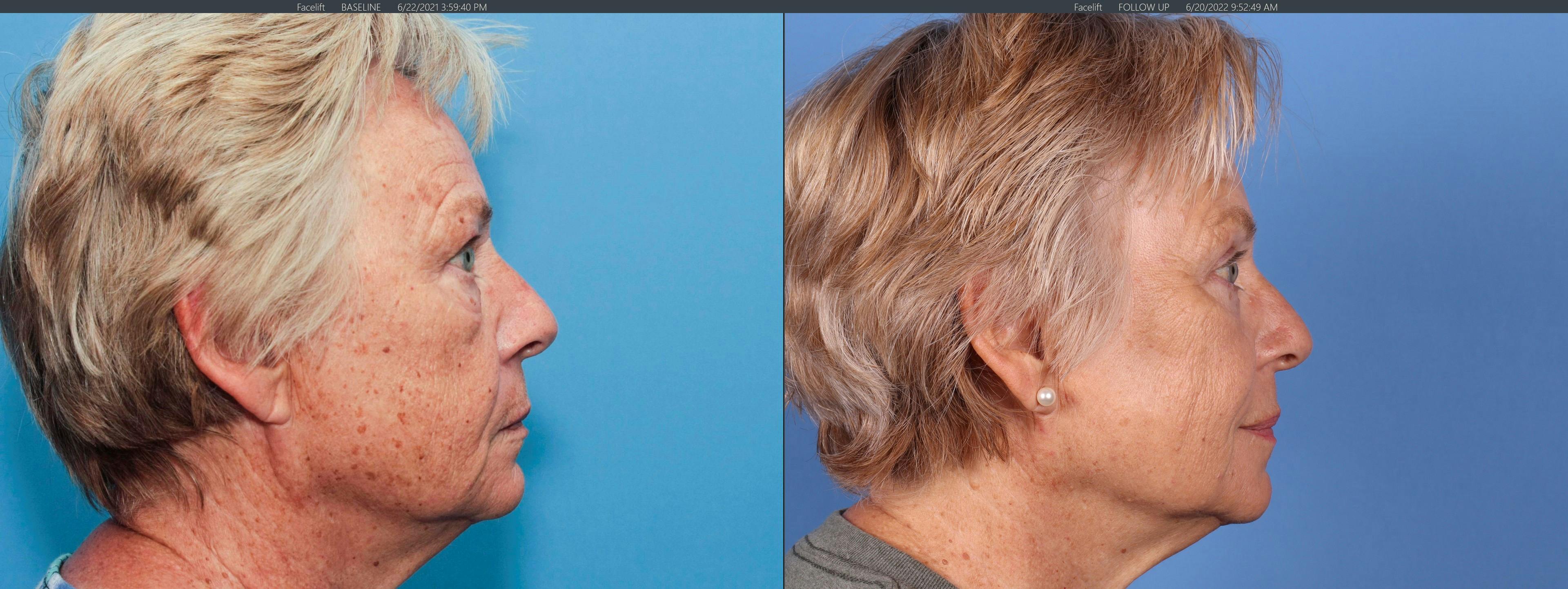 Eyelid Surgery (Upper & Lower Blepharoplasty) Before & After Gallery - Patient 277885 - Image 3