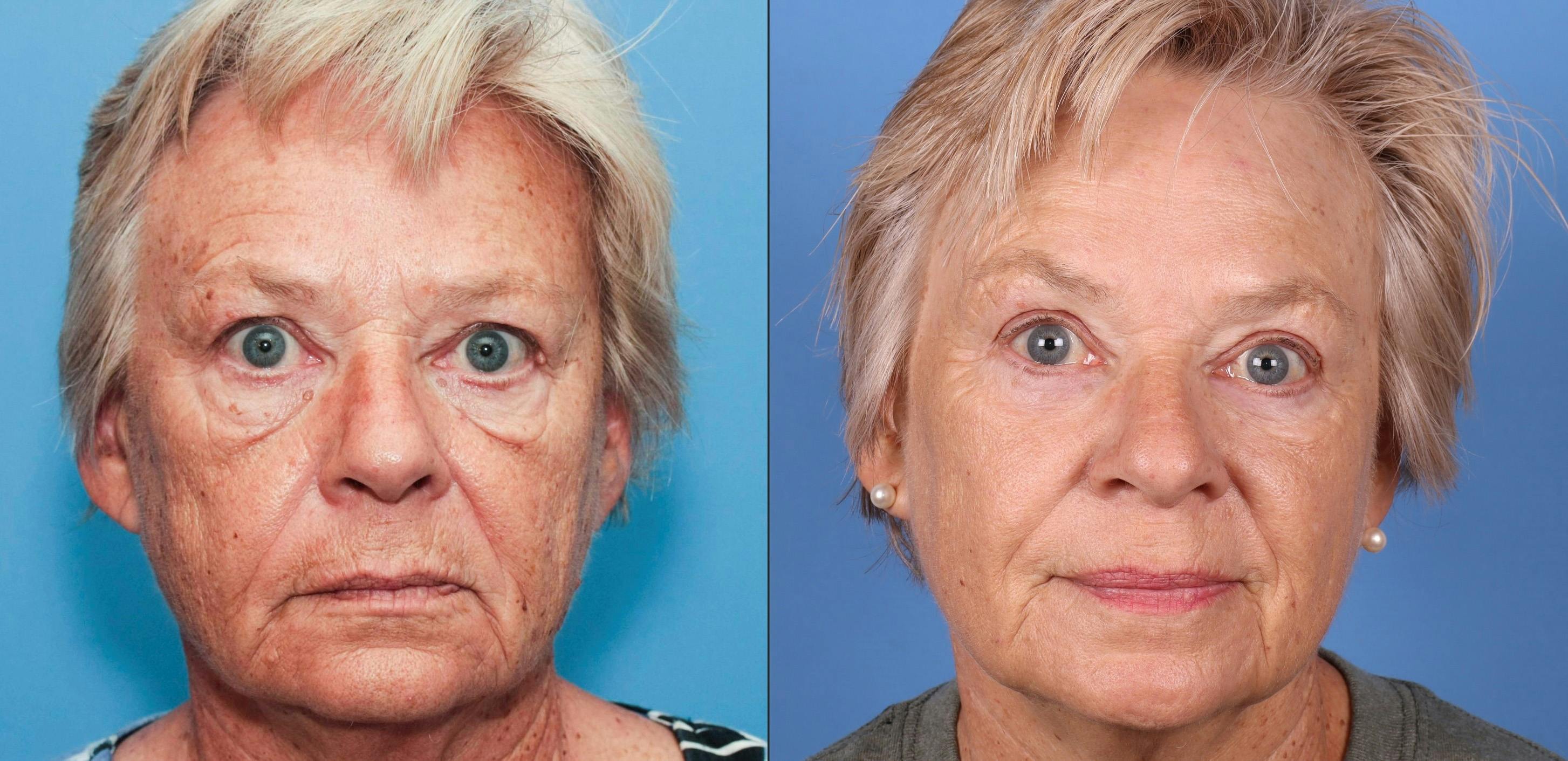 Eyelid Surgery (Blepharoplasty) Before & After Gallery - Patient 122393774 - Image 1