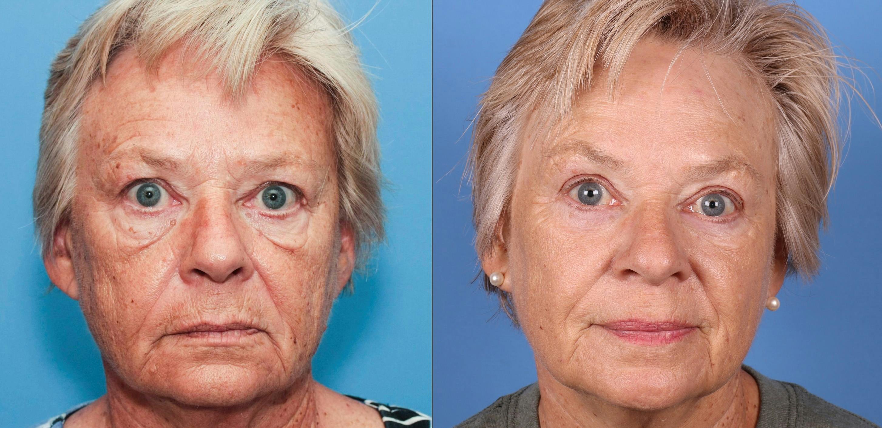 Eyelid Surgery (Upper & Lower Blepharoplasty) Before & After Gallery - Patient 277885 - Image 1