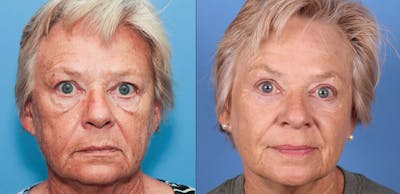 Eyelid Surgery (Upper & Lower Blepharoplasty) Before & After Gallery - Patient 277885 - Image 1